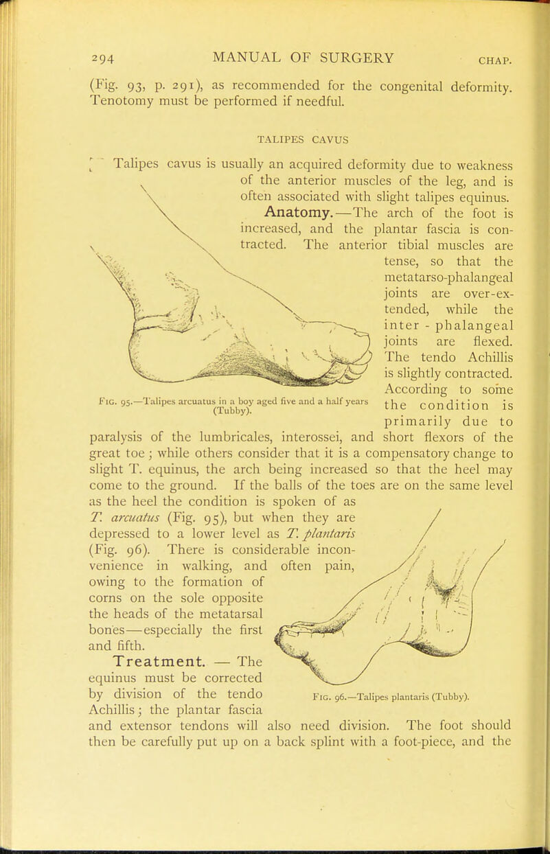 (i'ig- 93> P- 291), as recommended for the congenital deformity. Tenotomy must be performed if needful. TALIPES CAVUS Fig. 95.—Talipes arcuatus in a boy aged five and a half years (Tubby). Talipes cavus is usually an acquired deformity due to weakness of the anterior muscles of the leg, and is often associated with slight talipes equinus. Anatomy.—The arch of the foot is increased, and the plantar fascia is con- tracted. The anterior tibial muscles are tense, so that the metatarso-phalangeal joints are over-ex- tended, while the inter - phalangeal joints are flexed. The tendo Achillis is slightly contracted. According to soine the condition is primarily due to paralysis of the lumbricales, interossei, and short flexors of the great toe; while others consider that it is a compensatory change to slight T. equinus, the arch being increased so that the heel may come to the ground. If the balls of the toes are on the same level as the heel the condition is spoken of as T. arcuatus (Fig. 95), but when they are / depressed to a lower level as T. plantaris (Fig. 96). There is considerable incon- venience in walking, and often pain, owing to the formation of corns on the sole opposite the heads of the metatarsal bones—especially the first and fifth. Treatment. — The equinus must be corrected by division of the tendo Achillis; the plantar fascia and extensor tendons will also need division. The foot should then be carefully put up on a back splint with a foot-piece, and the Fig. 96.—Talipes plantaris (Tubby).