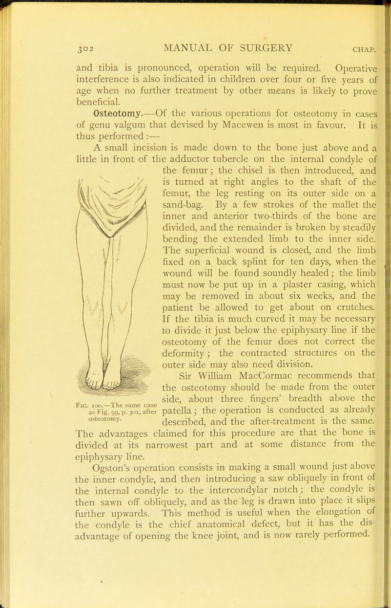 and tibia is pronounced, operation will be required. Operative interference is also indicated in children over four or five years of age when no further treatment by other means is likely to prove beneficial. Osteotomy.—Of the various operations for osteotomy in cases of genu valgum that devised by Macewen is most in favour. It is thus performed:— A small incision is made down to the bone just above and a little in front of the adductor tubercle on the internal condyle of the femur; the chisel is then introduced, and is turned at right angles to the shaft of the femur, the leg resting on its outer side on a sand-bag. By a few strokes of the mallet the inner and anterior two-thirds of the bone are divided, and the remainder is broken by steadily bending the extended limb to the inner side. The superficial wound is closed, and the limb fixed on a back splint for ten days, when the wound will be found soundly healed; the limb must now be put up in a plaster casing, which may be removed in about six weeks, and the patient be allowed to get about on crutches. If the tibia is much curved it may be necessary to divide it just below the epiphysary line if the osteotomy of the femur does not correct the deformity; the contracted structures on the outer side may also need division. Sir William MacCormac recommends that the osteotomy should be made from the outer side, about three fingers' breadth above the Fig. ioo.—The same case , , • ■ j j i i as Fig. 99, p. 301, after patella; the operation is conducted as already osteotomy. described, and the after-treatment is the same. The advantages claimed for this procedure are that the bone is divided at its narrowest part and at some distance from the epiphysary line. Ogston's operation consists in making a small wound just above the inner condyle, and then introducing a saw obliquely in front of the internal condyle to the intercondylar notch ; the condyle is then sawn off obliquely, and as the leg is drawn into place it slips further upwards. This method is useful when the elongation of the condyle is the chief anatomical defect, but it has the dis- advantage of opening the knee joint, and is now rarely performed.