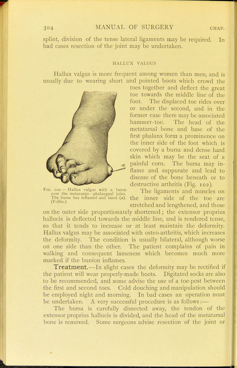 splint, division of the tense lateral ligaments naay be required. In bad cases resection of the joint may be undertaken. HALLUX VALGUS Hallux valgus is more frequent among women than men, and is usually due to wearing short and pointed boots which crowd the toes together and deflect the great toe towards the middle line of the foot. The displaced toe rides over or under the second, and in the former case there may be associated hammer-toe. The head of the metatarsal bone and base of the first phalanx form a prominence on the inner side of the foot which is covered by a bursa and dense hard skin which may be the seat of a painful corn. The bursa may in- flame and suppurate and lead to disease of the bone beneath or to destructive arthritis (Fig. 102). The ligaments and muscles on the inner side of the toe are stretched and lengthened, and those on the outer side proportionately shortened; the extensor proprius hallucis is deflected towards the middle line, and is rendered tense, so that it tends to increase or at least maintain the deformity. Hallux valgus may be associated with osteo-arthritis, which increases the deformity. The condition is usually bilateral, although worse on one side than the other. The patient complains of pain in walking and consequent lameness which becomes much more marked if the bunion inflames. Treatment.—In slight cases the deformity may be rectified if the patient will wear properly-made boots. Digitated socks are also to be recommended, and some advise the use of a toe-post between the first and second toes. Cold douching and manipulation should be employed night and morning. In bad cases an operation must be undertaken. A very successful procedure is as follows:— The bursa is carefully dissected away, the tendon of the extensor proprius hallucis is divided, and the head of the metatarsal bone is removed. Some surgeons advise resection of the joint or Fig. 102. — Hallux valgus wiih a bursa over the metacarpo - phalangeal joint. The bursa has inflamed and burst (a). (Follin.)