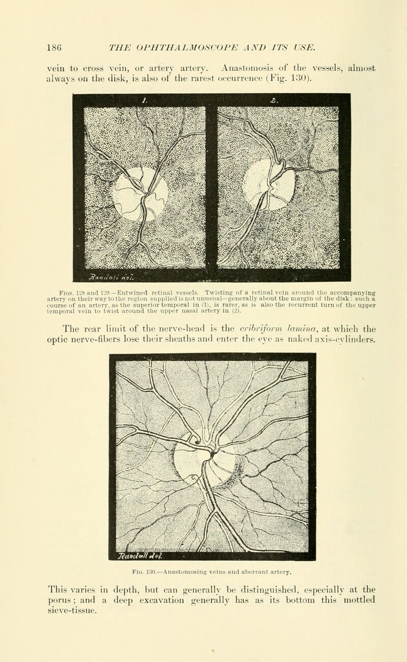 vein to cross vein, or artery artery. Anastomosis of the vessels, almost always on the disk, is also of the rarest occurrence (Fig. 130). Figs. 128and 129.—Entwined retinal vessels. Twisting of a retinal vein around the accompanying artery on their way to the region supplied is not unusual—generally about the margin of the disk: such a course of an artery, as the superior temporal in fl). is rarer, as is also the recurrent turn of the upper temporal vein to twist around the upper nasal artery in (2). The rear limit of the nerve-head is the cribriform lamina, at which the optic nerve-fibers lose their sheaths and enter the eye as naked axis-cylinders. Fig. 130.—Anastomosing veins and aberrant artery. This varies in depth, but can generally be distinguished, especially at the porus; and a deep excavation generally has as its bottom this mottled sieve-tissue.