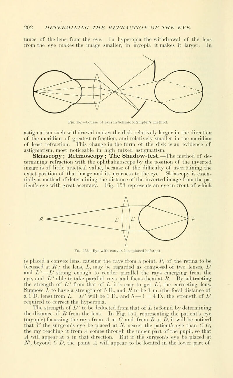 tance of the lens from the eye. In hyperopia the withdrawal of the lens from the eve makes the image smaller, in myopia it makes it larger. In astigmatism such withdrawal makes the disk relatively larger in the direction' of the meridian of greatest refraction, and relatively smaller in the meridian of least refraction. 'Phis change in the form of the disk is an evidence of astigmatism, most noticeable in high mixed astigmatism. Skiascopy; Retinoscopy; The Shadow-test.—The method of de- termining refraction with the ophthalmoscope hy the position of the inverted image is of little practical value, because of the difficulty of ascertaining the exact position of that image and its nearness to the eye. Skiascopy is essen- tially a method of determining the distance of the inverted image from the pa- tient's eye with great accuracy. Fig. 153 represents an eye in front of which Fig. 158.—Eye with convex lens placed before it. is placed a convex lens, causing the rays from a point, P, of the retina to he focussed at i? ; the lens, L, may be regarded as composed of two lenses, U and L—L' strong enough to render parallel the rays emerging from the eye, and L able to take parallel rays and focus them at J'. By subtracting the strength of L from that of L, it is easy to get L', the correcting lens. Suppose L to have a strength of 5 D., and R to be 1 m. (the focal distance of a 1 D. lens) from L. L will be 1 D., and 5— 1 =4D., the strength of L' required to correct the hyperopia. The strength of L to be deducted from that of L is found by determining the distance of R from the lens. In Fig. 154, representing the patient's eye (myopic) focussing the rays from .1 at C and from B at 1>, it will be noticed that if the surgeon's eye lie placed at .V, nearer the patient's eye than 0 D, the ray reaching it from A comes through the upper part of the pupil, so that A will appear at a in that direction. But if the surgeon's eye be placed at N', beyond (' I), the point .1 will appear to be located in the lower part of