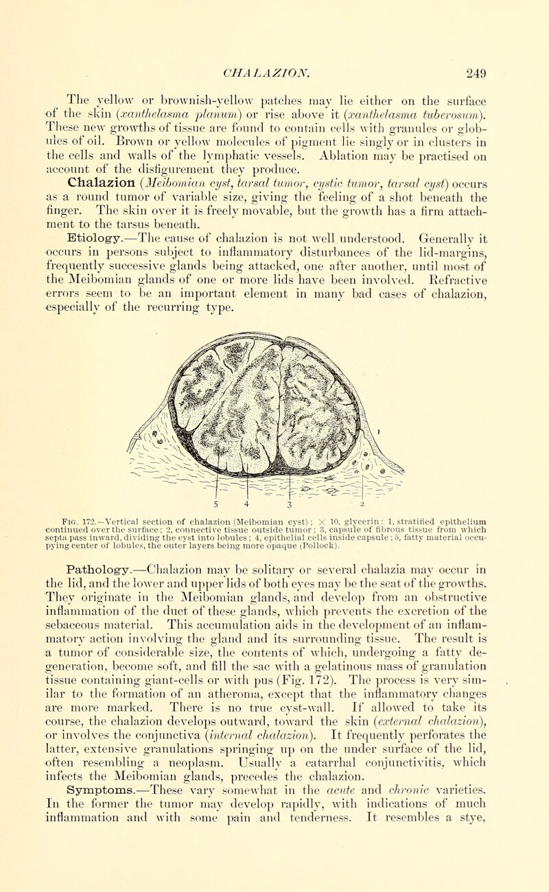 The yellow or brownish-yellow patches may lie either on the surface of the skin (xanthelasma planum) or rise above it (xanthelasma tuberosum). These new growths of tissue are found to contain cells with granules or glob- ules of oil. Brown or yellow molecules of pigment lie singly or in clusters in the cells and walls of the lymphatic vessels. Ablation may be practised on account of the disfigurement they produce. Chalazion (Meibomian cyst, tarsal tumor, cystic tumor, tarsal cyst) occurs as a round tumor of variable size, giving the feeling of a shot beneath the finger. The skin over it is freely movable, but the growth has a firm attach- ment to the tarsus beneath. Etiology.—The cause of chalazion is not well understood. Generally it occurs in persons subject to inflammatory disturbances of the lid-margins, frequently successive glands being attacked, one after another, until most of the Meibomian glands of one or more lids have been involved. Refractive errors seem to be an important element in many bad cases of chalazion, especially of the recurring type. Fig. 172.—Vertical section of chalazion (Meibomian cyst); X 10, glycerin: 1, stratified epithelium ■continued over the surface; 2, connective tissue outside tumor; :'.. capsule of fibrous tissue from which septa pass inward, dividing the cyst into lobules ; 4, epithelial cells inside capsule ; 5, fatty material occu- pying center of lobules, the outer layers being more opaque (.Pollock). Pathology.—Chalazion may be solitary or several chalazia may occur in the lid, and the lower and upper lids of both eyes may be the seat of the growths. They originate in the Meibomian glands, and develop from an obstructive inflammation of the duct of these glands, which prevents the excretion of the sebaceous material. This accumulation aids in the development of an inflam- matory action involving the gland and its surrounding tissue. The result is a tumor of considerable size, the contents of which, undergoing a fatty de- generation, become soft, and fill the sac with a gelatinous mass of granulation tissue containing giant-cells or with pus (Fig. 172). The process is very sim- ilar to the formation of an atheroma, except that the inflammatory changes are more marked. There is no true cyst-wall. If allowed to take its course, the chalazion develops outward, toward the skin (external chalazion), or involves the conjunctiva (internal chalazion). It frequently perforates the latter, extensive granulations springing up on the under surface of the lid, often resembling a neoplasm. Usually a catarrhal conjunctivitis, which infects the Meibomian glands, precedes the chalazion. Symptoms.—These vary somewhat in the acute and chronic varieties. In the former the tumor may develop rapidly, with indications of much inflammation and with some pain and tenderness. It resembles a stye,