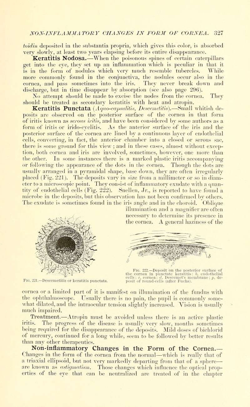 toidin deposited in the substantia propria, which gives this color, is absorbed very slowly, at least two years elapsing before its entire disappearance. Keratitis Nodosa.—When the poisonous sjmies of certain caterpillars get into the eye, they set up an inflammation which is peculiar in that it is in the form of nodules which very much resemble tubercles. While more commonly found in the conjunctiva, the nodules occur also in the cornea, and pass sometimes into the iris. They never break down and discharge, but in time disappear by absorption (see also page 296). No attempt should be made to excise the nodes from the cornea. They should be treated as secondary keratitis with heat and atropin. Keratitis Punctata (Aquo-capsulitis, Descemetitis).—Small whitish de- posits are observed on the posterior surface of the cornea in that form of iritis known as serous iritis, and have been considered by some authors as a form of iritis or irido-cyclitis. As the anterior surface of the iris and the posterior surface of the cornea are lined by a continuous layer of endothelial cells, converting, in fact, the anterior chamber into a closed or serous sac, there is some ground for this view ; and in these cases, almost without excep- tion, both cornea and iris are involved, sometimes, however, one more than the other. In some instances there is a marked plastic iritis accompanying or following the appearance of the dots in the cornea. Though the dots are usually arranged in a pyramidal shape, base down, they are often irregularly placed (Fig. 221). The deposits vary in size from a millimeter or so in diam- eter to a microscopic point. They consist of inflammatory exudate with a quan- tity of endothelial cells (Fig. 222). Snellen, Jr., is reported to have found a microbe in the deposits, but this observation has not been confirmed by others. The exudate is sometimes found in the iris angle and in the choroid. Oblique illumination and a magnifier are often ,., , necessary to determine its presence in _^> the cornea. A general haziness of the -Descemetitis or keratitis punctata. Fig. 222.—Deposit on the posterior surface of the cornea in punctate keratitis: b, endothelial cells; c, cornea: d, Descemet's membrane; p, de- posit of round-cells (after Fuchs). cornea or a limited part of it is manifest on illumination of the fundus with the ophthalmoscope. Usually there is no pain, the pupil is commonly some- what dilated, and the intraocular tension slightly increased. Vision is usually much impaired. Treatment.—Atropin must be avoided unless there is an active plastic iritis. The progress of the disease is usually very slow, months sometimes being required for the disappearance of the deposits. Mild doses of bichlorid of mercury, continued for a long while, seem to be followed by better results than any other therapeutics. Non-inflammatory Changes in the Form of the Cornea.— Changes in the form of the cornea from the normal—which is really that of a triaxial ellipsoid, but not very markedly departing from that of a sphere— are known as astigmatism. Those changes which influence the optical prop- erties of the eye that can be neutralized are treated of in the chapter