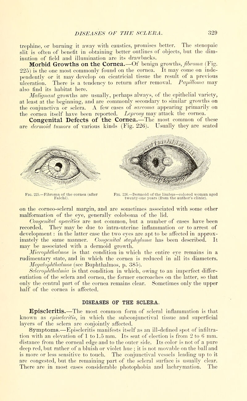 trephine, or burning it away with caustics, promises better. The stenopaic slit is often of benefit in obtaining better outlines of objects, but the dim- inution of field and illumination are its drawbacks. Morbid Growths on the Cornea.—Of benign growths, fibroma (Fig. 225) is the one most commonly found on the cornea. It may come on inde- pendently or it may develop on cicatricial tissue the result of a previous ulceration. There is a tendency to return after removal. Papilloma may also find its habitat here. Malignant growths are usually, perhaps always, of the epithelial variety, at least at the beginning, and are commonly secondary to similar growths on the conjunctiva or sclera. A few cases of sarcoma appearing primarily on the cornea itself have been reported. Leprosy may attack the cornea. Congenital Defects of the Cornea.—The most common of these are dermoid tumors of various kinds (Fig. 226). Usually they are seated ■\\JH^l^ limbus—colored woman aged om the author's clinic). on the corneo-scleral margin, and are sometimes associated with some other malformation of the eye, generally coloboma of the lid. Congenital opacities are not common, but a number of cases have been recorded. They may be due to intra-uterine inflammation or to arrest of development : in the latter case the two eyes are apt to be affected in approx- imately the same manner. Congenital staphyloma has been described. It may be associated with a dermoid growth. Microphthalmos is that condition in which the entire eye remains in a rudimentary state, and in which the cornea is reduced in all its diameters. Megalophthalmos (see Buphthalmos, p. 385). Sclerophthalmia is that condition in which, owing to an imperfect differ- entiation of the sclera and cornea, the former encroaches on the latter, so that only the central part of the cornea remains clear. Sometimes only the upper half of the cornea is affected. DISEASES OF THE SCLERA. Episcleritis.—The most common form of scleral inflammation is that known as episcleritis, in which the subconjunctival tissue and superficial layers of the sclera are conjointly affected. Symptoms.—Episcleritis manifests itself as an ill-defined spot of infiltra- tion with an elevation of 1 to 1.5 mm. Its seat of election is from 2 to 6 mm. distance from the corneal edge and to the outer side. Its color is not of a pure deep red, but rather of a bluish or violet hue ; it is not movable on the ball and is more or less sensitive to touch. The conjunctival vessels leading up to it are congested, but the remaining part of the scleral surface is usually clear. There are in most cases considerable photophobia and lachrymation. The