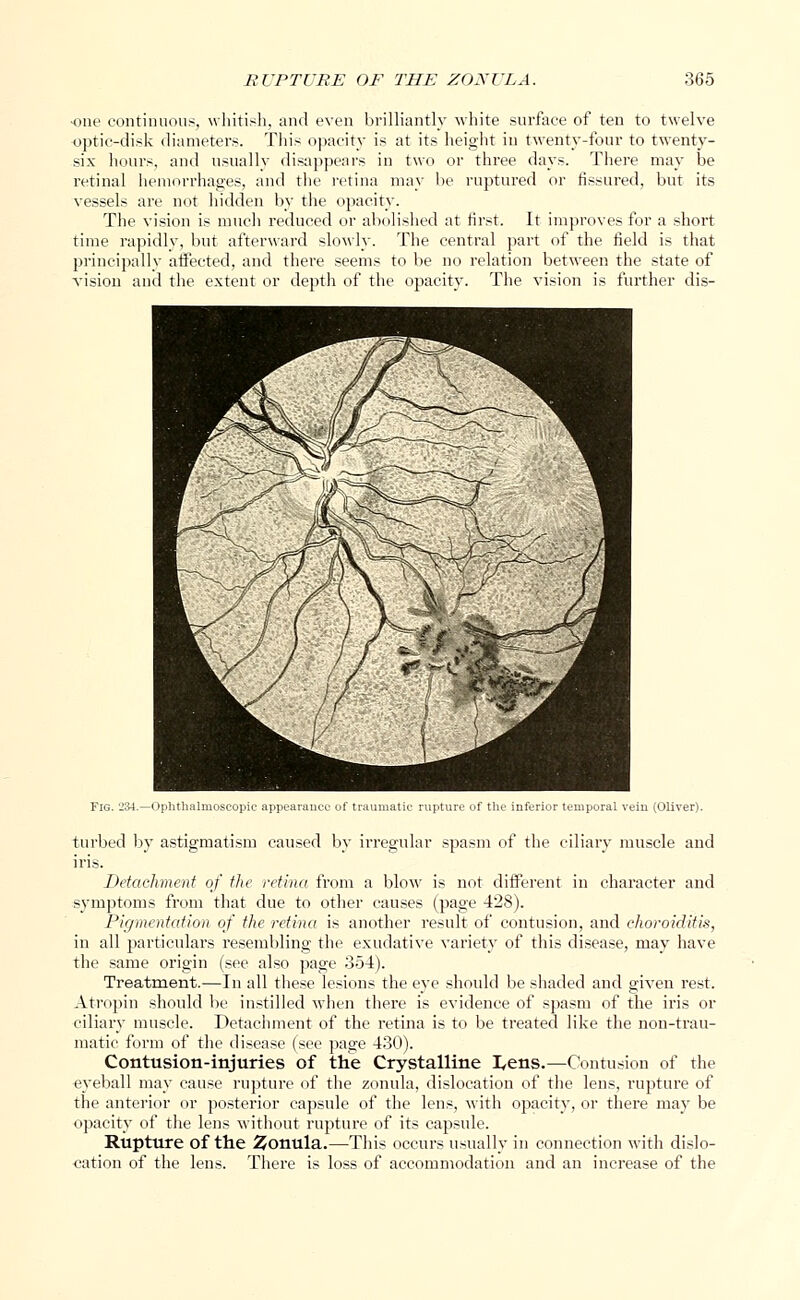 one continuous, whitish, and even brilliantly white surface of ten to twelve optic-disk diameters. This opacity is at its height in twenty-four to twenty- six hours, and usually disappears in two or three days. There may be retinal hemorrhages, and the retina may be ruptured or fissured, but its vessels are not hidden by the opacity. The vision is much reduced or abolished at first. It improves for a short time rapidly, but afterward slowly. The central part of the field is that principally affected, and there seems to be no relation between the state of vision and the extent or depth of the opacity. The vision is further dis- Fig. 234.—Ophthalmoscopic appearance of traumatic rupture of the inferior temporal vein (Oliver). turbed by astigmatism caused by irregular spasm of the ciliary muscle and iris. Detachment of the retina, from a blow is not different in character and symptoms from that due to other causes (page 428). Pigmentation of the retina is another result of contusion, and choroiditis, in all particulars resembling the exudative variety of this disease, may have the same origin (see also page 354). Treatment.—In all these lesions the eye should be shaded and given rest. Atropin should be instilled when there is evidence of spasm of the iris or ciliary muscle. Detachment of the retina is to be treated like the non-trau- matic form of the disease (see page 430). Contusion-injuries of the Crystalline I,ens.—Contusion of the eyeball may cause rupture of the zonula, dislocation of the lens, rupture of the anterior or posterior capsule of the lens, with opacity, or there may be opacity of the lens without rupture of its capsule. Rupture of the Zonula.—This occurs usually in connection with dislo- cation of the lens. There is loss of accommodation and an increase of the