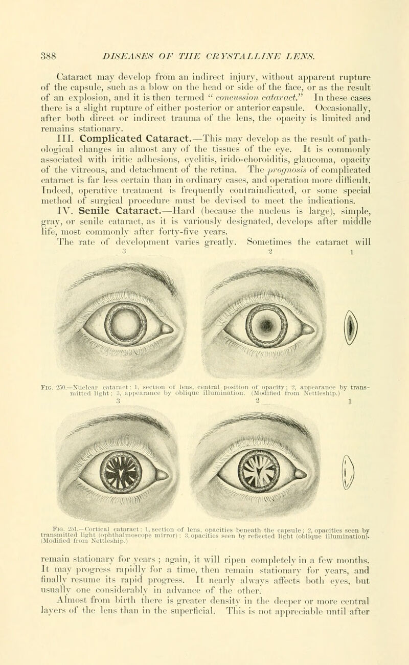 Cataract may develop from an indirect injury, without apparent rupture of the capsule, such as a blow on the head or side of the face, or as the result of an explosion, and it is then termed  concussion cataract. In these cases there is a slight rupture of either posterior or anterior capsule. Occasionally, after both direct or indirect trauma of the lens, the opacity is limited and remains stationary. III. Complicated Cataract.—This may develop as the result of path- ological changes in almost any of the tissues of the eye. It is commonly associated with iritic adhesions, cyclitis, irido-ehoroiditis, glaucoma, opacity of the vitreous, and detachment of the retina. The 'prognosis of complicated cataract is far less certain than in ordinary eases, and operation more difficult. Indeed, operative treatment is frequently contraindicated, or some special method of surgical procedure must be devised to meet the indications. IV. Senile Cataract.—Hard (because the nucleus is large), simple, gray, or senile cataract, as it is variously designated, develops after middle life, most commonly after forty-five years. The rate of development varies greatly. Sometimes the cataract will FIG. 250.—Nuclear cataract : I. section of lens, central position .if opacity ; L'. appearance by trans- mitted light; 3, appearance by oblique illumination. (Modified from Nettleship.) Fig. 251.- Cortical cataract : 1. section of lens, opacities beneath the capsule ; 2, opacities seen by transmitted lirdit ophthalmoscope niirron : ::.,.pacifies seen by reflected li-M (oblique illumination). (Modified from Nettleship.) remain stationary for years ; again, it will ripen completely in a few months. It may progress rapidly for a time, then remain stationary for years, and finally resume its rapid progress. It nearly always affects both eve-, but usually one considerably in advance of the other. Almost from birth there is greater density in the deeper or more central layers of the lens than in the superficial. This is not appreciable until after