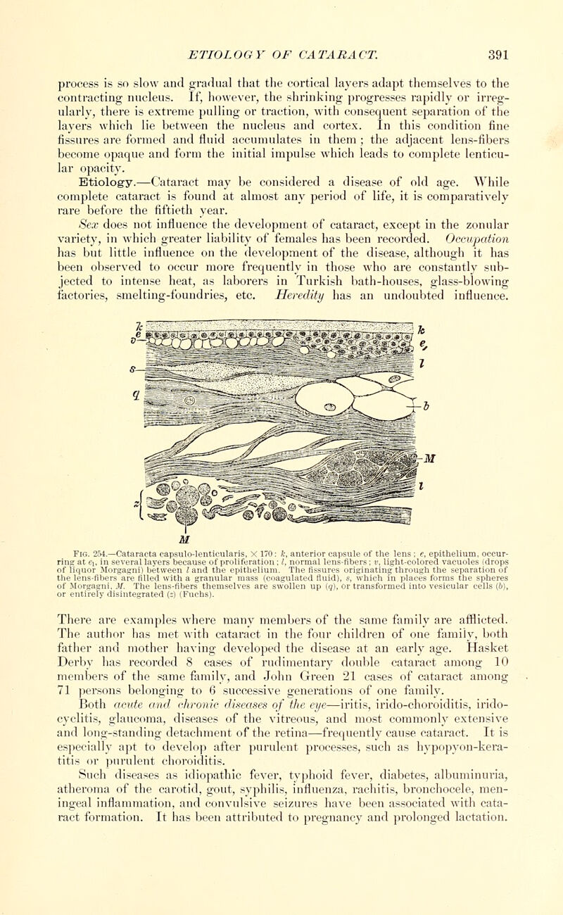 process is so slow and gradual that the cortical layers adapt themselves to the contracting nucleus. If, however, the shrinking progresses rapidly or irreg- ularly, there is extreme pulling or traction, with consequent separation of the layers which lie between the nucleus and cortex. In this condition fine fissures are formed and fluid accumulates in them ; the adjacent lens-fibers become opaque and form the initial impulse which leads to complete lenticu- lar opacity. Etiology.—Cataract may be considered a disease of old age. While complete cataract is found at almost any period of life, it is comparatively rare before the fiftieth year. Sex does not influence the development of cataract, except in the zonular variety, in which greater liability of females has been recorded. Occupation has but little influence on the development of the disease, although it has been observed to occur more frequently in those who are constantly sub- jected to intense heat, as laborers in Turkish bath-houses, glass-blowing factories, smelting-fouudries, etc. Heredity has an undoubted influence. Fk;. 254.—Cataracta capsulo-lenticularis, X 170: k, anterior capsule of the lens: e, epithelium, occur- ring ;it -;. in -<-Y.-ral layers because of proliferation ; /, normal lens-fibers ; y, light-colored vacuoles (drops of lienor M-.r.'.iuiiii between Zand the epithelium. The lissures originating through the separation of the len<-tibcr- are tilled with a granular mass (coagulated fluid), s, which in places forms the spheres of Morgagni. M. The lens-libers themselves are swollen up (q), or transformed into vesicular cells (6), or entirely disintegrated (-) (Fuehs). There are examples where many members of the same family are afflicted. The author has met with cataract in the four children of one family, both father and mother having developed the disease at an early age. Hasket Derby has recorded 8 cases of rudimentary double cataract among 10 members of the same family, and John Green 21 cases of cataract among 71 persons belonging to 6 successive generations of one family. Both acute and chronic diseases of the eye—iritis, irido-choroiditis, irido- cyclitis, glaucoma, diseases of the vitreous, and most commonly extensive and long-standing detachment of the retina—frequently cause cataract. It is especially apt to develop after purulent processes, such as hypopyon-kera- titis or purulent choroiditis. Such diseases as idiopathic fever, typhoid fever, diabetes, albuminuria, atheroma of the carotid, gout, syphilis, influenza, rachitis, bronchocele, men- ingeal inflammation, and convulsive seizures have been associated with cata- ract formation. It has been attributed to pregnancy and prolonged lactation.