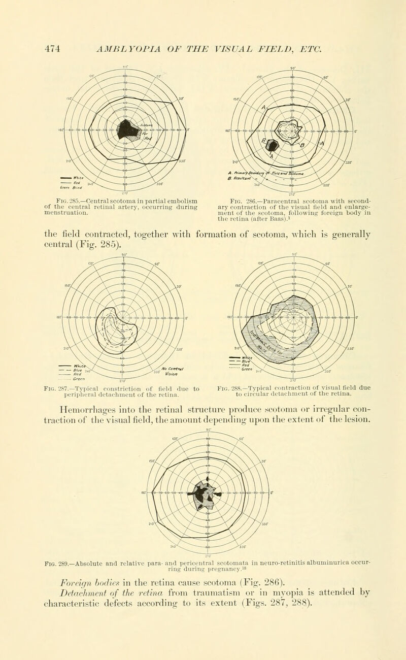 Fig. 285.—Central scotoma in partial embolism of the central retina] artery, occurring during menstruation. Fig. 286.—Paracentral scotoma with second- ary contraction of the visual field and enlarge- ment of the scotoma, following foreign body in the retina (after Baas).' the field contracted, together with formation of scotoma, which is generally central (Fig. 285). mC nXVt I i( •■V •~~1 V ^fe^ '^J</ \\ \ ///*' \/Ab Cent*/ ■ Green -^° Hirer Fir,. 2S7.— Typical constriction of field due to peripheral detachment of the retina. Hemorrhages into the retinal structure produce scotoma or irregular con- traction of the visual field, the amount depending upon the extent of the lesion. Fig. 289.—Absolute and relati para- and pericentral scotomata ring during pregnancy.18 neuro-retinitis albuminurica occur- Foreif/n hntlie.* in the retina cause scotoma (Fig. 286). Detachment of the retina from traumatism or in myopia is attended by characteristic defects according to its extent (Figs. 287, 288).