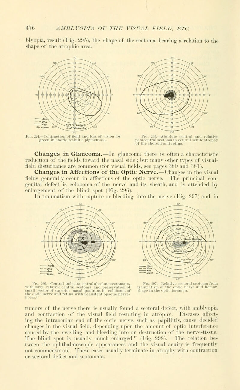 blyopia, result (Fig. 295), the shape of the scotoma bearing a relation to the shape of the atrophic area. '7Y/ ^MV &?*Xj^TT\ J T~) T^v^v^c / / / / \Sc^ ,X X/- »i.'I\  > /^^Ai*/ *fcb*r2Jr^\/ G/W» ^^-^2 £53^ Fig. 294.—Contraction of field and loss of vis green in chorio-retinitis pigmentosa. Fig. 295.—Absoluti ntral and relative paracentral sent, .ma in central senile atrophy of Hie choroid and retina. Changes in Glaucoma.—In glaucoma there is often a characteristic reduction of the fields toward the nasal side ; but many other types of visual- field disturbance axe common (for visual fields, see pages 380 and 381). Changes in Affections of the Optic Nerve.—Changes in the visual fields generally occur in affections of the optic nerve. The principal con- genital defect is coloboma of the nerve and its sheath, and is attended by enlargement of the blind spot (Fig. 296). In traumatism with rupture or bleeding into the nerve (Fi,u'. 297) and in Fig. 296.—Central and paracentral absolute seotomata, Fig. 297.- Relative sectoral scotoma from withlarge relative central scotoma and preservation of traumatism of the optic nerve and hemor- small sector of superior nasal quadrant in colobomaof rhage in the optic foramen. the optic nerve and retina w ith persistent opaque nerve- fibers.1' tumors of the nerve there is usually found a sectoral defect, with amblyopia and contraction of the visual field resulting in atrophy. Diseases affect- ing the intraocular end of the optic nerve, such as papillitis, cause decided changes in the visual field, depending upon the amount of optic interference caused ltv the swelling and bleeding into or destruction of the nerve-tis6ue. The blind spot is usually much enlarged17 (Fig. 298). The relation be- tween the ophthalmoscopic appearances and the visual acuity is frequently not commensurate. These cases usually terminate in atrophy with contraction or sectoral defect and seotomata.