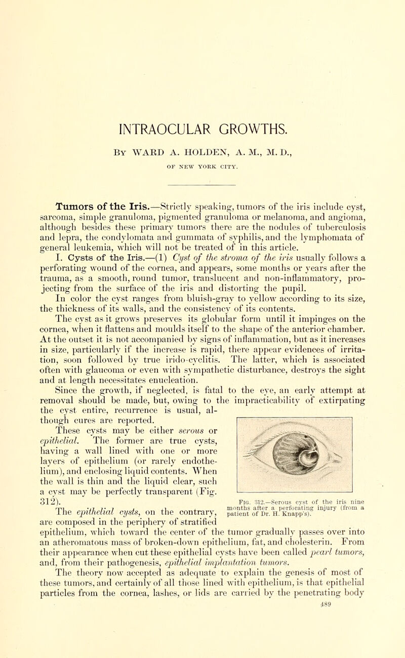 INTRAOCULAR GROWTHS. By WARD A. HOLDEN, A. M., M. D. OF NEW YORK CITY. Tumors of the Iris.—Strictly speaking, tumors of the iris include cyst, sarcoma, simple granuloma, pigmented granuloma or melanoma, and angioma, although besides these primary tumors there are the nodules of tuberculosis and lepra, the condylomata and gummata of syphilis, and the lymphomata of general leukemia, which will not be treated of in this article. I. Cysts of the Iris.—(1) Cyst of the stroma of the iris usually follows a perforating wound of the cornea, and appears, some months or years after the trauma, as a smooth, round tumor, translucent and non-inflammatory, pro- jecting from the surface of the iris and distorting the pupil. In color the cyst ranges from bluish-gray to yellow according to its size, the thickness of its walls, and the consistency of its contents. The cyst as it grows preserves its globular form until it impinges on the cornea, when it flattens and moulds itself to the shape of the anterior chamber. At the outset it is not accompanied by signs of inflammation, but as it increases in size, particularly if the increase is rapid, there appear evidences of irrita- tion, soon followed by true iridocyclitis. The latter, which is associated often with glaucoma or even with sympathetic disturbance, destroys the sight and at length necessitates enucleation. Since the growth, if neglected, is fatal to the eye, an early attempt at removal should be made, but, owing to the impracticability of extirpating the cyst entire, recurrence is usual, al- though cures are reported. These cysts may be either serous or epithelial. The former are true cysts, having a wall lined with one or more layers of epithelium (or rarely endothe- lium), and enclosing liquid contents. When the wall is thin and the liquid clear, such a cyst may be perfectly transparent (Fig. 312). Fig. 312.—Serous cyst of the iris nine rni -.1 7*7 i xt. months after a perforating injurv (from a 1 he epithelial cysts, on the contrary, patient of Dr. h. Knapps). are composed in the periphery of stratified epithelium, which toward the center of the tumor gradually passes over into an atheromatous mass of broken-down epithelium, fat, and cholesterin. From their appearance when cut these epithelial cysts have been called pearl tumors, and, from their pathogenesis, epithelial implantation tumors. The theory now accepted as adequate to explain the genesis of most of these tumors, and certainly of all those lined with epithelium, is that epithelial particles from the cornea, lashes, or lids are carried by the penetrating body