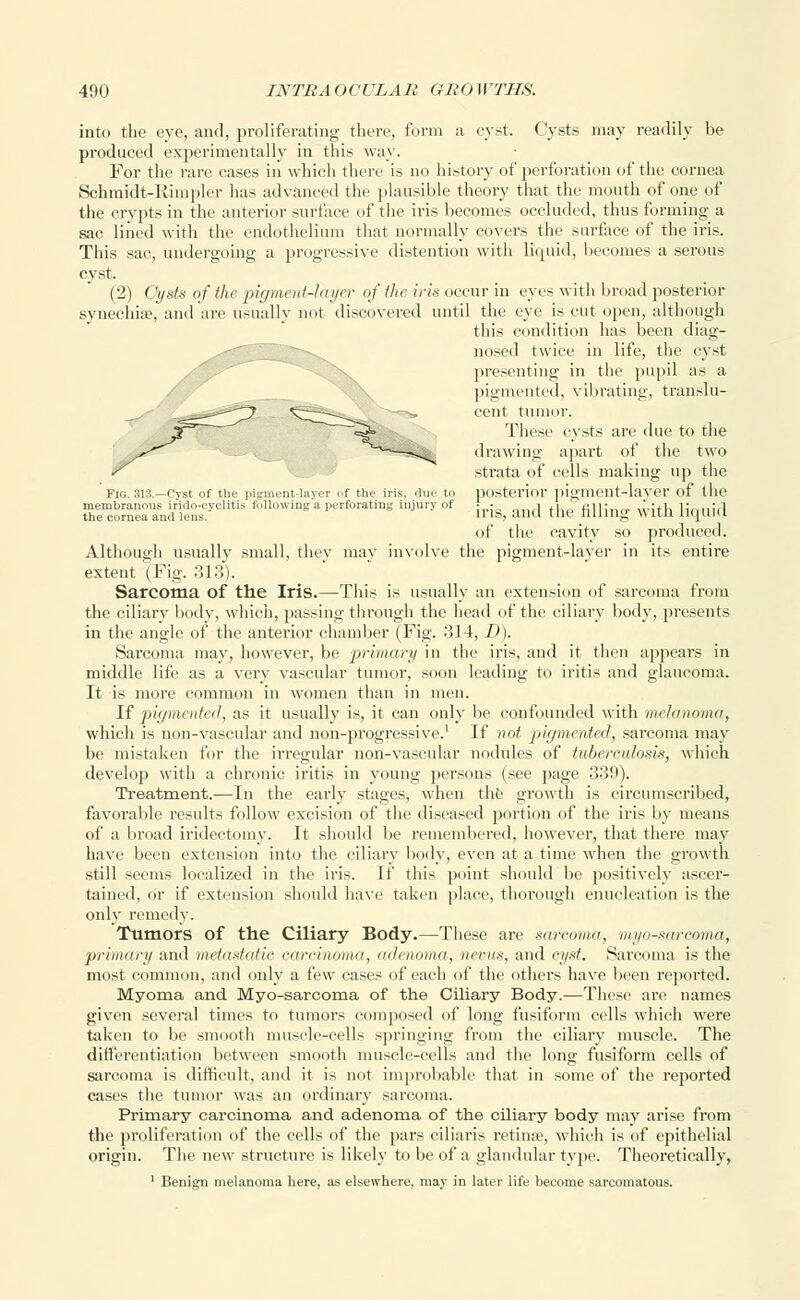 into the eye, and, proliferating there, form a cyst. Cysts may readily be produced experimentally in this way. For the rare cases in which there is no history of perforation of the cornea Schmidt-Rimpler has advanced the plausible theory that the mouth of one of the crypts in the anterior surface of the iris becomes occluded, thus forming a sac lined with the endothelium that normally covers the surface of the iris. This sac, undergoing a progressive distention with liquid, becomes a serous cyst. (2) Oysts of the pigment-layer of the iris occur in eyes with broad posterior synechia?, and are usually not discovered until the eye is cut open, although this condition has been diag- nosed twice in life, the cyst presenting in the pupil as a pigmented, vibrating, translu- cent tumor. These cysts are due to the drawing apart of the two strata of cells making up the Fig. 313.—Cyst of the pigment-layer of the iris, due to posterior pigmeut-laver of the membranous iridocyclitis following a perforating injury of • • j ,. fill- _, :,|tl. i;nll;,l the cornea and lens. lllt'> ana tll(- tilling \\ ltn liquid of the cavity so produced. Although usually small, they may involve the pigment-layer in its entire extent (Fig. 313). Sarcoma of the Iris.—This is usually an extension of sarcoma from the ciliary body, which, passing through the head of the ciliary body, presents in the angle of the anterior chamber (Fig. 314, D). Sarcoma may, however, be primary in the iris, and it then appears in middle life as a very vascular tumor, soon leading to iritis and glaucoma. It is more common in women than in men. If pigmented, as it usually is, it can only be confounded with melanoma, which is non-vascular and non-progressive.1 If not pigmented, sarcoma may be mistaken for the irregular non-vascular nodules of tuberculosis, which develop with a chronic iritis in young persons (see page 339). Treatment.—In the early stages, when the growth is circumscribed, favorable results follow excision of the diseased portion of the iris by means of a broad iridectomy. It should be remembered, however, that there may have been extension into the ciliary body, even at a time when the growth still seems localized in the iris. If this point should be positively ascer- tained, or if extension should have taken place, thorough enucleation is the only remedy. Tumors of the Ciliary Body.—These are sarcoma, myosarcoma, primary and metastatic carcinoma, adenoma, nevus, and cyst. Sarcoma is the most common, and only a few cases of each of the others have been reported. Myoma and Myo-sarcoma of the Ciliary Body.—These are names given several times to tumors composed of long fusiform cells which were taken to be smooth muscle-cells springing from the ciliary muscle. The differentiation between smooth muscle-cells and the long fusiform cells of sarcoma is difficult, and it is not improbable that in some of the reported cases the tumor was an ordinary sarcoma. Primary carcinoma and adenoma of the ciliary body may arise from the proliferation of the cells of the pars ciliaris retina?, which is of epithelial origin. The new structure is likely to be of a glandular type. Theoretically, 1 Benign melanoma here, as elsewhere, may in later life become sarcomatous.