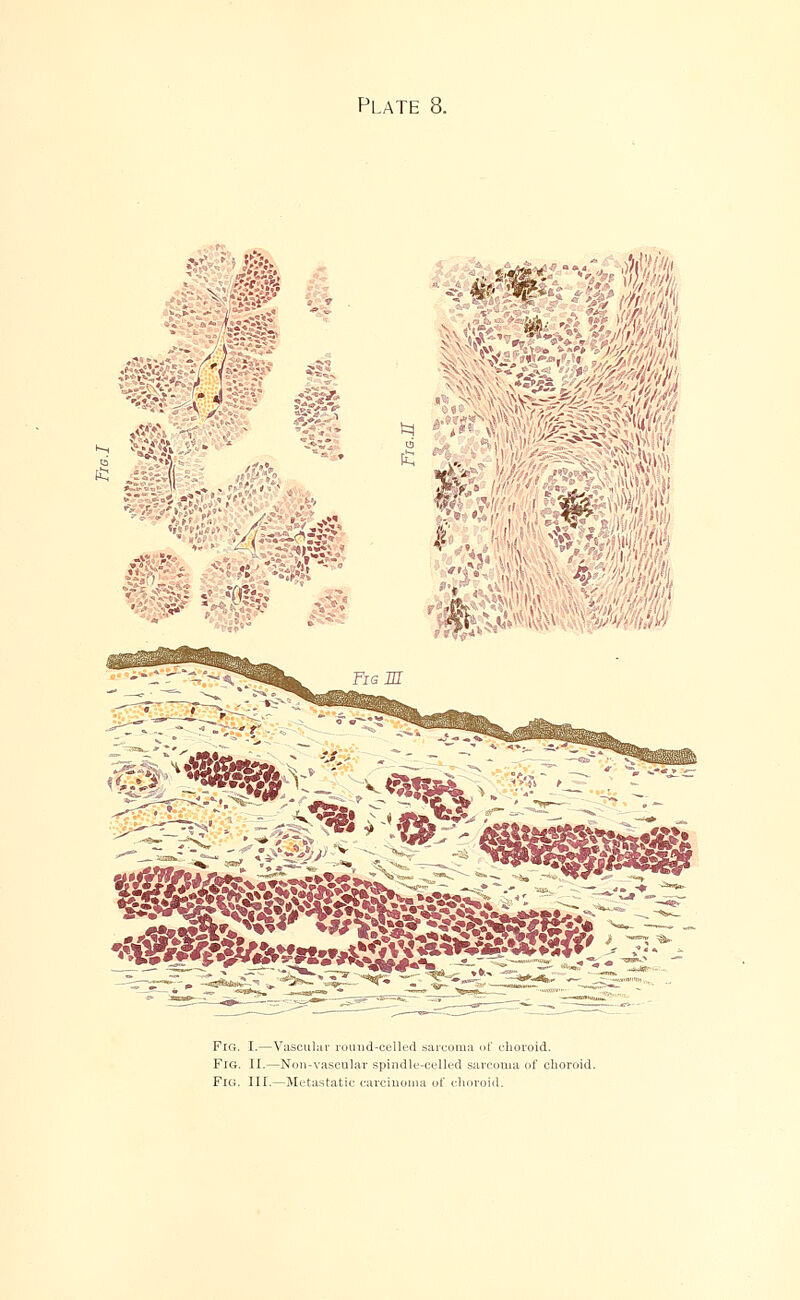 Plate 8. .V ..- ,' « 452* mm . > ' '% JJ4 t.'\V . *' * Fig. I.—Vascular round-celled sarcoma of choroid. Fig. II.—Non-vascular spindle-celled sarcoma of choroid. Fig. III.—Metastatic carcinoma of choroid.