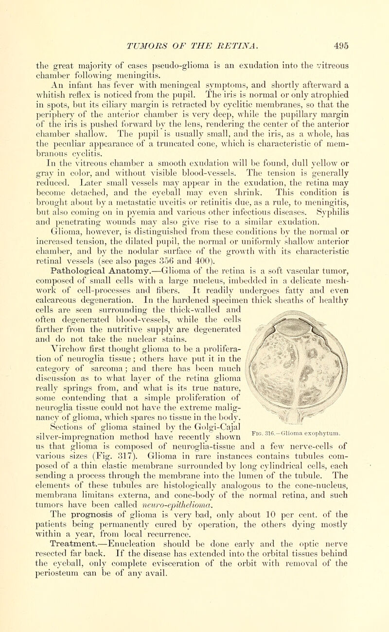 the gi'eat majority of cases pseudo-glioma is an exudation into the vitreous chamber following meningitis. An infant has fever with meningeal symptoms, and shortly afterward a whitish reflex is noticed from the pupil. The iris is normal or only atrophied in spots, but its ciliary margin is retracted by cyclitic membranes, so that the periphery of the anterior chamber is very deep, while the pupillary margin of the iris is pushed forward by the lens, rendering the center of the anterior chamber shallow. The pupil is usually small, and the iris, as a whole, has the peculiar appearance of a truncated cone, which is characteristic of mem- branous cyclitis. In the vitreous chamber a smooth exudation will be found, dull yellow or gray in color, and without visible blood-vessels. The tension is generally reduced. Later small vessels may appear in the exudation, the retina may become detached, and the eyeball may even shrink. This condition is brought about by a metastatic uveitis or retinitis due, as a rule, to meningitis, but also coming on in pyemia and various other infectious diseases. Syphilis and penetrating wounds may also give rise to a similar exudation. Glioma, however, is distinguished from these conditions by the normal or increased tension, the dilated pupil, the normal or uniformly shallow anterior chamber, and by the nodular surface of the growth with its characteristic retinal vessels (see also pages 356 and 400). Pathological Anatomy.—Glioma of the retina is a soft vascular tumor, composed of small cells with a large nucleus, imbedded in a delicate mesh- work of cell-processes and fibers. It readily undergoes fatty and even calcareous degeneration. In the hardened specimen thick sheaths of healthy cells are seen surrounding the thick-walled and often degenerated blood-vessels, while the cells J* farther from the nutritive supply are degenerated % and do not take the nuclear stains. / Virchow first thought glioma to be a prolifera- / tion of neuroglia tissue ; others have put it in the / ^Y\ category of sarcoma; and there has been much fi discussion as to what layer of the retina glioma \ v // really springs from, and what is its true nature, \ some contending that a simple proliferation of neuroglia tissue could not have the extreme malig- nancy of glioma, which spares no tissue in the body. Sections of glioma stained by the Golgi-Cajal ■1 • „ j.1' i.1 l l * j.1  1 Fig. 316. — Glioma exophvtum. silver-impregnation method have recently shown us that glioma is composed of neuroglia-tissue and a few nerve-cells of various sizes (Fig. 317). Glioma in rare instances contains tubules com- posed of a thiu elastic membrane surrounded by long cylindrical cells, each sending a process through the membrane into the lumen of the tubule. The elements of these tubules are histologically analogous to the cone-nucleus, membrana limitans externa, and cone-body of the normal retina, and such tumors have been called neuro-epithclioma. The prognosis of glioma is very bad, only about 10 per cent, of the patients being permanently cured by operation, the others dying mostly within a year, from local recurrence. Treatment.—Enucleation should be done early and the optic nerve resected far back. If the disease has extended into the orbital tissues behind the eyeball, only complete evisceration of the orbit with removal of the periosteum can be of any avail.