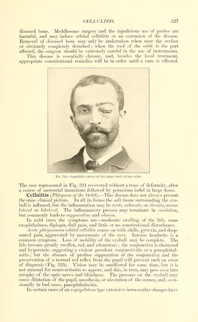 diseased bone. Meddlesome surgery and the injudicious use of probes are harmful, and may induce orbital cellulitis or an extension of the disease. Removal of diseased bone may only be undertaken when near the surface or obviously completely detached; when the roof of the orbit is the part affected, the surgeon should be extremely careful in the use of instruments. This disease is essentially chronic, and, besides the local treatment, appropriate constitutional remedies will be in order until a cure is effected. Fig. 324.—Syphilitic caries of the inner wail of th The case represented in Fig. 324 recovered without a trace of deformity, after a course of mercurial inunctions followed by potassium iodid in large doses. Cellulitis (Phlegmon of the Orbit).—This disease does not always present- the same clinical picture. In all its forms the soft tissue surrounding the eye- ball is inflamed, but the inflammation may be acute, subacute, or chronic, mono- lateral or bilateral. The inflammatory process may terminate in resolution, but commonly leads to suppuration and abscess. In mild cases the symptoms are—moderate swelling of the lids, some exophthalmos, diplopia, dull pain, and little or no constitutional disturbance. Acute phlegmonous orbital cellulitis conies on with chills, pyrexia, and deep- seated pain, aggravated by movements of the eyes. Intense headache is a common symptom. Loss of mobility of the eyeball may be complete. The lids become greatly swollen, red, and edematous ; the conjunctiva is chemosed and hyperemic, suggesting a violent purulent conjunctivitis or a panophthal- mitis; but the absence of profuse suppuration of the conjunctiva and the preservation of a normal red reflex from the pupil will prevent such an error of diagnosis (Fig. 325). Vision may be unaffected for some time, but it is not unusual for neuro-retinitis to appear, and this, in turn, may pass over into atrophy of the optic nerve and blindness. The pressure on the eyeball may cause dilatation of the pupil, anesthesia, or ulceration of the cornea, and, occa- sionally in bad cases, panophthalmitis. In certain cases of an erysipelatous type extensive intra-ocular changes have
