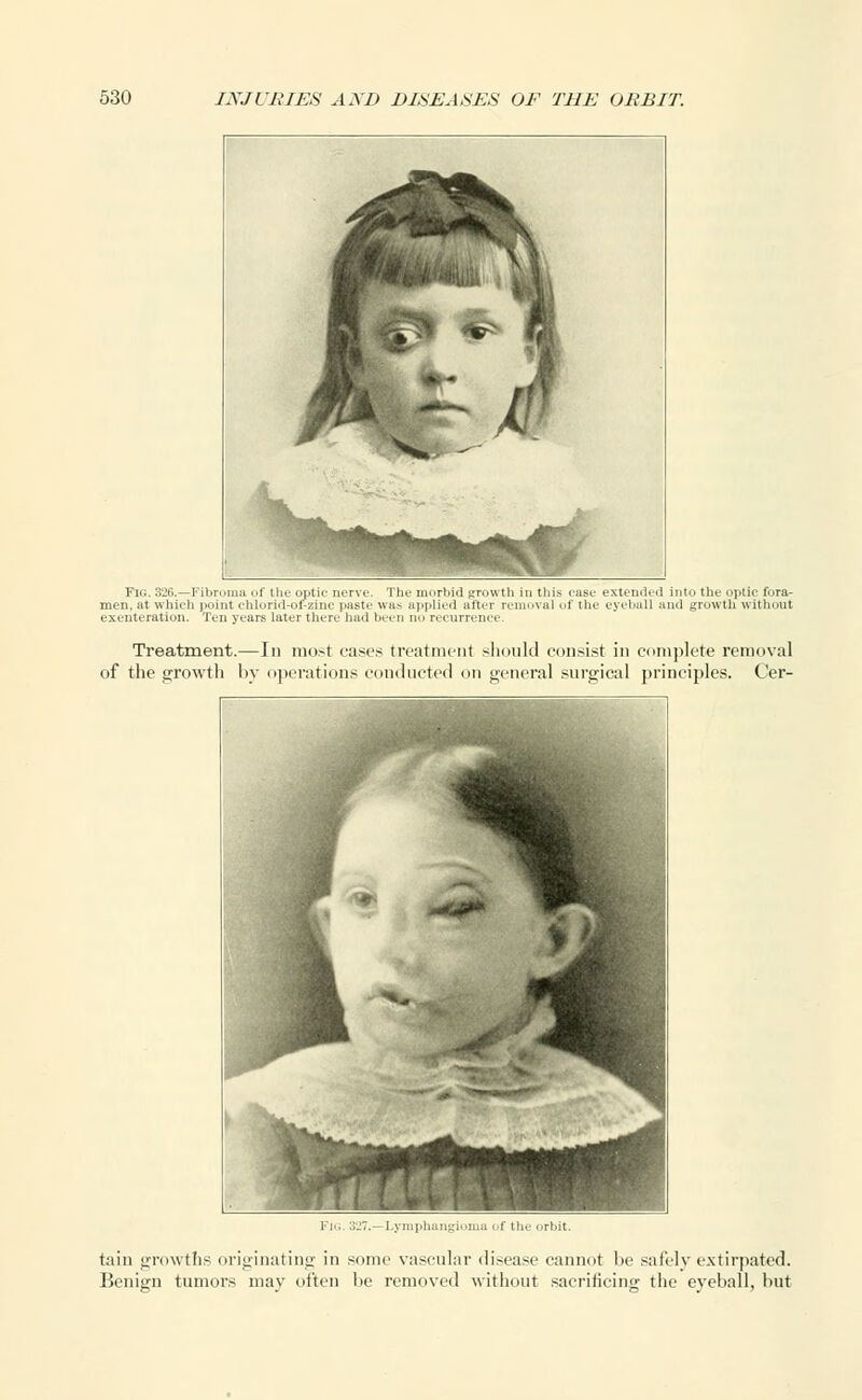 Fig. 326.—Fibroma of tin- optic nerve. The morbid growth in this ease extended into the optic fora- men, at which point ehlorid-of-zinc paste was applied after removal of the eyeball and growth without exenteration. Ten years later there had been no recurrence. Treatment.—In most eases treatment should consist in complete removal of the growth by operations conducted on general surgical principles. Cer- flHHH -Lymphangioma of the orbit. tain growths originating in some vascular disease cannot be safely extirpated. Benign tumors may often be removed without sacrificing the eyeball, but