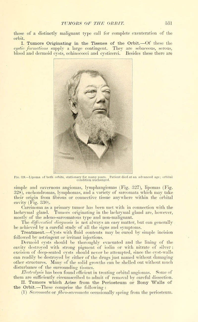 those of a distinctly malignant type call for complete exenteration of the orbit. I. Tumors Originating- in the Tissues of the Orbit.—Of these the cystic formations supply a large contingent. They are sebaceous, serous, blood and dermoid cysts, echinococci and cysticerci. Besides these there are simple and cavernous angiomas, lymphangiomas (Fig. 327), lipomas (Fig. 328), enchondromas, lymphomas, and a variety of sarcomata which may take their origin from fibrous or connective tissue anywhere within the orbital cavity (Fig. 330). Carcinoma as a primary tumor has been met with in connection with the lachrymal gland. Tumors originating in the lachrymal gland are, however, mostly of the adeno-sarcomatons type and non-malignant. The differential diagnosis is not always an easy matter, but can generally be achieved by a careful study of all the signs and symptoms. Treatment.—Cysts with fluid contents may be cured by simple incision followed by astringent or irritant injections. Dermoid cysts should be thoroughly evacuated and the lining of the cavity destroyed with strong pigment of iodin or with nitrate of silver: excision of deep-seated cysts should never be attempted, since the cyst-walls can readily be destroyed by either of the drugs just named without damaging other structures. Many of the solid growths can be shelled out without much disturbance of the surrounding tissues. Electrolysis has been found efficient in treating orbital angiomas. Some of them are sufficiently circumscribed to admit of removal bv careful dissection. II. Tumors which Arise from the Periosteum or Bony Walls of the Orbit.—-These comprise the following : (1) Sarcomata or fibro-sarcomata occasionally spring from the periosteum.