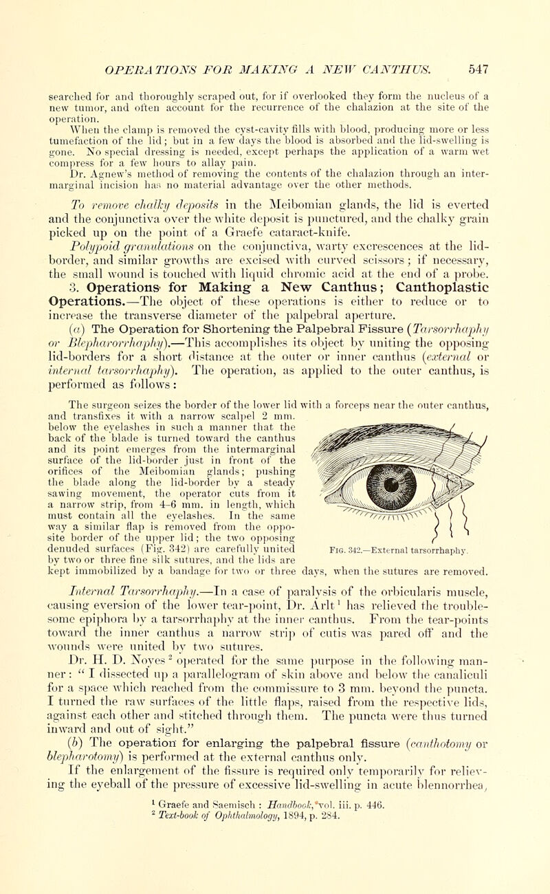 searched for and thoroughly scraped out, for if overlooked they form the nucleus of a new tumor, and often account for the recurrence of the chalazion at the site of the operation. When the clamp is removed the cyst-cavity fills with blood, producing more or less tumefaction of the lid; but in a few days the blood is absorbed and the lid-swelling is gone. No special dressing is needed, except perhaps the application of a warm wet compress for a few hours to allay pain. Dr. Agnew's method of removing the contents of the chalazion through an inter- marginal incision has no material advantage over the other methods. To remove chalky deposits in the Meibomian glands, the lid is everted and the conjunctiva over the white deposit is punctured, and the chalky grain picked up on the point of a Graefe cataract-knife. Polypoid granulations on the conjunctiva, warty excrescences at the lid- border, and similar growths are excised with curved scissors; if necessary, the small wound is touched with liquid chromic acid at the end of a probe. 3. Operations- for Making a New Canthus; Canthoplastic Operations.—The object of these operations is either to reduce or to increase the transverse diameter of the palpebral aperture. (a) The Operation for Shortening the Palpebral Fissure (Tarsorrhaphy or Blepharorrhaphy).—This accomplishes its object by uniting the opposing lid-borders for a short distance at the outer or inner canthus (external or internal tarsorrhaphy). The operation, as applied to the outer canthus, is performed as follows: The surgeon seizes the border of the lower lid with a forceps near the outer canthus, and transfixes it with a narrow scalpel 2 mm. below the eyelashes in such a manner that the back of the blade is turned toward the canthus and its point emerges from the iutermarginal surface of the lid-border just in front of the orifices of the Meibomian glands; pushing the blade along the lid-border by a steady sawing movement, the operator cuts from it a narrow strip, from 4-6 mm. in length, which must contain all the eyelashes. In the same way a similar flap is removed from the oppo- site border of the upper lid; the two opposing denuded surfaces (Fig. 342) are carefully united by two or three fine silk sutures, and the lids are kept immobilized by a bandage for two or three days, when the sutures are removed. Internal Tarsorrhaphy.—In a case of paralysis of the orbicularis muscle, causing eversion of the lower tear-point, Dr. Arlt1 has relieved the trouble- some epiphora by a tarsorrhaphy at the inner canthus. From the tear-points toward the inner canthus a narrow strip of cutis was pared off and the wounds were united by two sutures. Dr. H. D. Noyes2 operated for the same purpose in the following man- ner:  I dissected up a parallelogram of skin above and below the canaliculi for a space which reached from the commissure to 3 mm. beyond the puncta. I turned the raw surfaces of the little flaps, raised from the respective lids, against each other and stitched through them. The puncta were thus turned inward and out of sight. (h) The operation for enlarging- the palpebral fissure (canthotomy or blepharotomy) is performed at the external canthus only. If the enlargement of the fissure is required only temporarily for reliev- ing the eyeball of the pressure of excessive lid-swelling in acute blennorrhea, 1 Graefe and Saemisch : Handbook,*\ol. iii. p. 446. 2 Text-book of Ophthalmology, 1894, p. 284. Fig. 342.—External tarsorrhaphy.