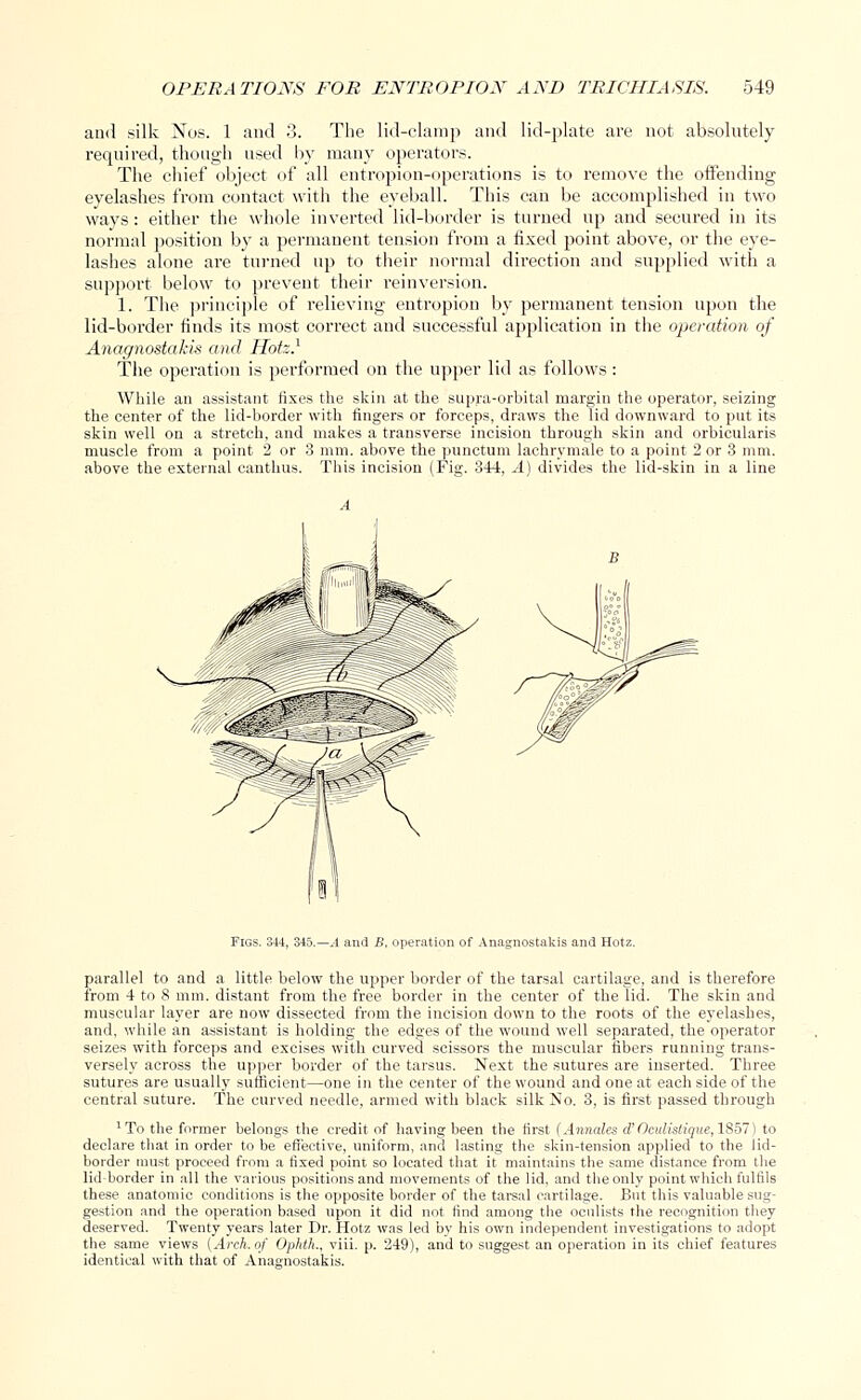 and silk Nos. 1 and 3. The lid-clamp and lid-plate are not absolutely required, though used by many operators. The chief object of all entropion-operations is to remove the offending eyelashes from contact with the eyeball. This can be accomplished in two ways: either the whole inverted lid-border is turned up and secured in its normal position by a permanent tension from a fixed point above, or the eye- lashes alone are turned up to their normal direction and supplied with a support below to prevent their reinversion. 1. The principle of relieving entropion by permanent tension upon the lid-border rinds its most correct and successful application in the operation of Anagnostakis and Hotz.1 The operation is performed on the upper lid as follows : While an assistant fixes the skin at the supra-orbital margin the operator, seizing the center of the lid-border with fingers or forceps, draws the lid downward to put its skin well on a stretch, and makes a transverse incision through skin and orbicularis muscle from a point 2 or 3 mm. above the punctum lachrymale to a point 2 or 3 mm. above the external canthus. This incision (Fig. 344, A) divides the lid-skin in a line Figs. 344, 345.—A and B, operation of Anagnostakis and Hotz. parallel to and a little below the upper border of the tarsal cartilage, and is therefore from 4 to 8 mm. distant from the free border in the center of the lid. The skin and muscular layer are now dissected from the incision down to the roots of the eyelashes, and, while an assistant is holding the edges of the wound well separated, the operator seizes with forceps and excises with curved scissors the muscular fibers running trans- versely across the upper border of the tarsus. Next the sutures are inserted. Three sutures are usually sufficient—one in the center of the wound and one at each side of the central suture. The curved needle, armed with black silk No. 3, is first passed through 1 To the former belongs the credit of having been the first (Annates d' Ocvlistique, 1857) to declare that in order to be effective, uniform, and lasting the skin-tension applied to the lid- border must proceed from a fixed point so located that it maintains the same distance from the lid-border in all the various positions and movements of the lid, and the only point which fulfils these anatomic conditions is the opposite border of the tarsal cartilage. But this valuable sug- gestion and the operation based upon it did not find among the oculists the recognition they deserved. Twenty years later Dr. Hotz was led by his own independent investigations to adopt the same views [Arch, of Ophth., viii. p. 249), and to suggest an operation in its chief features identical with that of Anagnostakis.