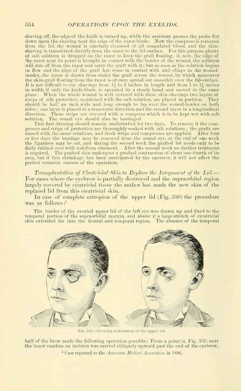 shaving off, the edgeof the knife is turned up, while the assistant presses the probe flat down upon the shaving near the edge of the razor-blade. Now the compress is removed from the lid. the wound is carefully cleansed <if all coagulated blood, and the skin- shaving is transferred directly from the razor to the lid-surface. For this purpose plenty of salt solution is dropped on the razor ti> keep the graft floating: if, now, the edge of the razor near its point is brought in contact with the border of the wound, the solution will run otf from the razor and carry the graft with it ; but as soon as the solution begins to flow and tic edge of the graft lias come in contact with and clings to the wound- border, the razor is drawn from under the graft across the wound, by which maneuver the skin-graft floating from the razor is at once spread out smoothly over the lid-surface. It is not difficult to cut shavings from l\ to 2 inches in length and from 1 to lh inches in width if only the knife-blade is operated by a steady hand and moved in the same plane. When the whole wound i> well covered with these skin-shavings two layers of strips of silk protective, moistened with the salt solution, are placed in position. They should be half an inch wide and long enough to lap over the wound-border on both sides ; one layer is placed in a transverse direction and the second layer in a longitudinal direction. These strips are covered with a compress which is to be kept wet with salt solution. The sound eye should also be bandaged. This first dressing should remain undisturbed fur two days. To remove it the com- presses and strips of protective are thoroughly soaked with salt solutions ; the grafts are rinsed with the same solutions, and fresh strips ami compresses are applied. After four or five days the bandage may be removed from the sound eye. at the end of one week the ligatures may be cut, and during the second week the grafted lid needs only to be daily rubbed over with iodoform ointment. After the second week no further treatment is required. The grafted skin undergoes a gradual contraction of about one-fourth of its area, but if this shrinkage has been anticipated by the operator, it will not affect the perfect cosmetic success of the operation. Transplantation of Cicatricial skin to Replace the Integument of the Lid.— For cases where the eyebrow is partially destroyed and the supraorbital region largely covered by cicatricial tissue the author litis made the new skin of the replaced lid from this cicatricial skin. In case of complete ectropion of the upper lid (Fig. 350) the procedure was as follows :l The border of the everted upper lid of the left eye was drawn up and fixed to the temporal portion of the supraorbital margin, and above it a large stretch of cicatricial skin extended far into the frontal and temporal region. The absence of the temporal half of the brow made the following operation possible: From a point (a. Fig. 351) near the inner eanthus an incision was carried obliquely upward past the end of the eyebrow, 1 Case reported to the American Medical Association in 1S96.