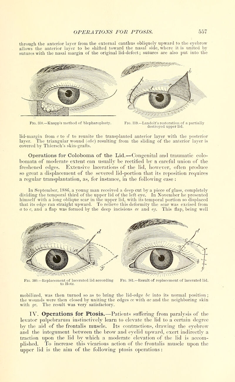 through the anterior layer from the external canthus obliquely upward to the eyebrow allows the anterior layer to be shifted toward the nasal side, where it is united by sutures with the nasal margin of the original lid-defect; sutures are also put into the Fig. 35S.—Knapp's method of blepharoplasty. Fig. 359.—Landolt's restoration of a partially destroyed upper lid. lid-margin from e to d to reunite the transplanted anterior layer with the posterior layer. The triangular wound (abc) resulting from the sliding of the anterior layer is covered by Thiersch's skin-grafts. Operations for Coloboma of the Lid.—Congenital and traumatic colo- bomata of moderate extent can usually be rectified by a careful union of the freshened edges. Extensive lacerations of the lid, however, often produce so great a displacement of the severed lid-portion that its reposition requires a regular transplantation, as, for instance, in the following case : In September, 1886, a young man received a deep cut by a piece of glass, completely dividing the temporal third of the upper lid of the left eye. In November he presented himself with a long oblique scar in the upper lid, with its temporal portion so displaced that its edge ran straight upward. To relieve this deformity the scar was excised from a to c, and a flap was formed by the deep incisions ce and eg. This flap, being well mobilized, was then turned so as to bring the lid-edge be into its normal position ; the wounds were then closed by uniting the edges ce with ac and the neighboring skin with ge. The result was very satisfactory. IV. Operations for Ptosis.—Patients suffering from paralysis of the levator palpebrarum instinctively learn to elevate the lid to a certain degree by the aid of the frontalis muscle. Its contractions, drawing the eyebrow and the integument between the brow and eyelid upward, exert indirectly a traction upon the lid by which a moderate elevation of the lid is accom- plished. To increase this vicarious action of the frontalis muscle upon the upper lid is the aim of the following ptosis operations: