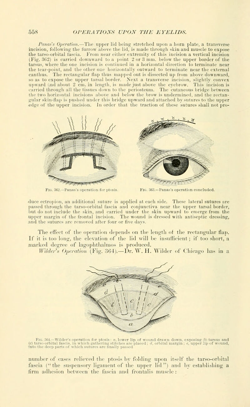 Panas's Operation.—The upper lid being stretched upon a horn plate, a transverse incision, following the furrow above the lid, is made through skin and muscle to expose the tarso-orbital fascia. From near either extremity of this incision a vertical incision (Fig. 362) is carried downward to a point 2 or 3 mm. below the upper border of the tarsus, where the one incision is continued in a horizontal direction to terminate near the tear-point, and the other one horizontally outward to terminate near the external canthus. The rectangular flap thus mapped out is dissected up from above downward, so as to expose the upper tarsal border. Next a transverse incision, slightly convex upward ind about 2 cm. in length, is made just above the, eyebrow. This incision is carried through all the tissues down to the periosteum. The cutaneous bridge between the two horizontal incisions above and below the brow is undermined, and the rectan- gular skin-flap is pushed under this bridge upward and attached by sutures to the upper •edge of the upper incision. In order that the traction of these sutures shall not pro- Fig. 362.—Panas's operation for ptosis. -I'anas's operation concluded. •duce ectropion, an additional suture is applied at each side. These lateral sutures are passed through the tarso-orbital fascia and conjunctiva near the upper tarsal border, but do not include the skin, and carried under the skin upward to emerge from the upper margin of the frontal incision. The wound is dressed with antiseptic dressing, and the sutures arc removed after four or five davs. of the operation depends on the length of the rectangular Hap. If it is too long, the elevation of the lid will be insufficient; if too short, a The effect marked degree of lagophthalnios is produced. Wader's Operation (Fig. 364).—Dr. W. H. Wildei if Chicago has in a Fig. 364.—Wilder's operation for ptosis: a. lower lip of wound drawn down, exposing [b) tarsus and (<-i tarso-orbital fascia, in which gathering stitcher are plural: </. orbital margin : /:, tipper Mp of wound, into the deep p;crts of which sutures are finally passed number id' eases relieved the ptosis by folding upon itself the tarso-orbital fascia (the suspensory ligament of the upper lid) and by establishing a firm adhesion between the fascia and frontalis muscle :