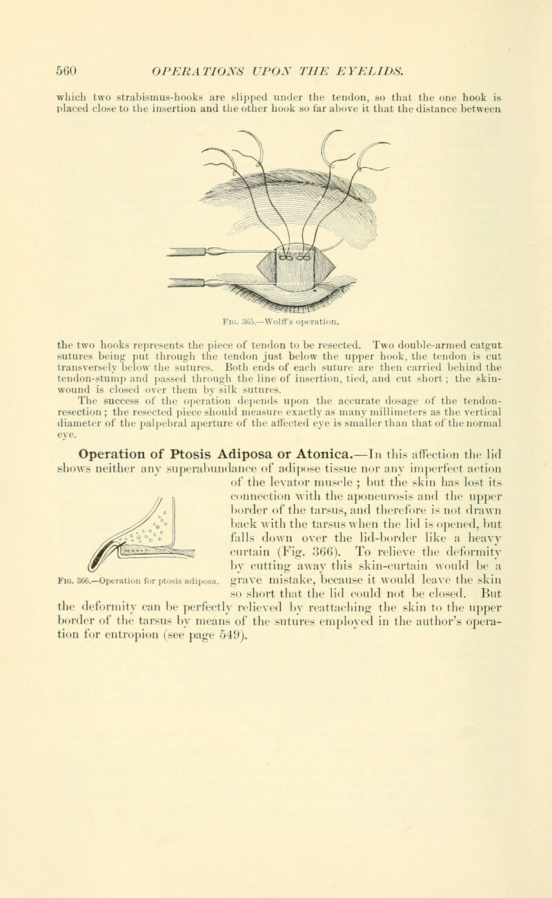 which two strabismus-hooks are slipped under the tendon, so that the one hook is placed close to the insertion and the other hook so tar above it that the distance between the two hooks represents the piece of tendon to be resected. Two double-armed catgut sutures being put through the tendon just below the upper hook, the tendon is cut transversely below the sutures. Both ends of each suture are then carried behind the tendon-stump and passed through the line of insertion, tied, and cut short; the skin- wound is closed over them by silk sutures. The success of the operation depends upon the accurate dosage of the tendon- resection ; the resected piece should measure exactly as many millimeters as the vertical diameter of the palpebral aperture of the affected eye is smaller than that of the normal eye. Operation of Ptosis Adiposa or Atonica.—In this affection the lid shows neither any superabundance of adipose tissue nor any imperfect action of the levator muscle ; hut the skin has lost its connection with the aponeurosis and the upper border of the tarsus, and therefore is not drawn back with the tarsus when the lid is opened, but falls down over the lid-border like a heavy curtain (Fig. 366). To relieve the deformity by cutting away this skin-curtain would be a grave mistake, because it would leave the skin so short that the lid could not be closed. But the deformity can be perfectly relieved by reattaching the skin to the upper border of the tarsus by means of the sutures employed in the author's opera- tion for entropion (see page 549). Fig. 366.—Operation fur ptosis adiposa.