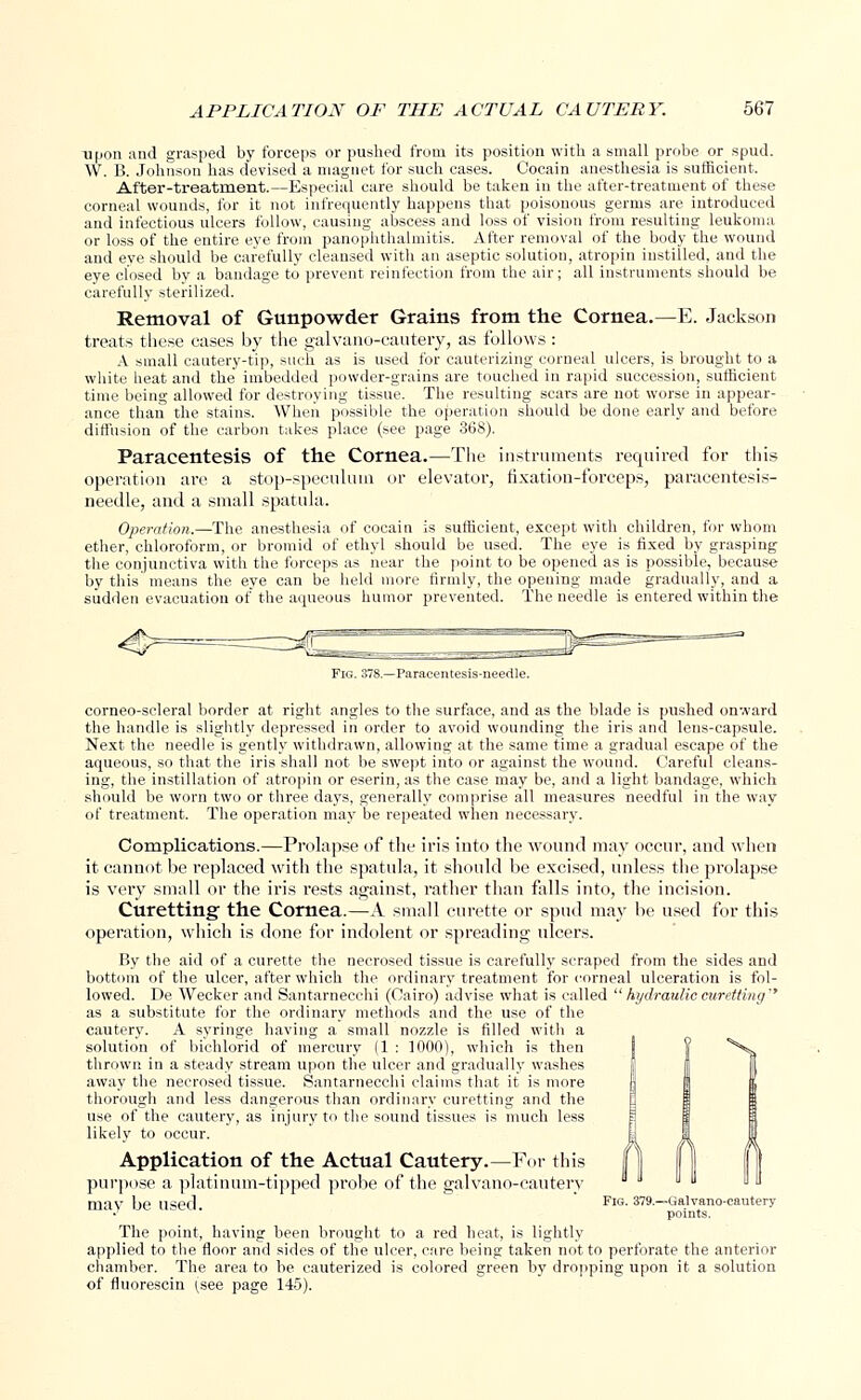 upon and grasped by forceps or pushed from its position with a small probe or spud. W. B. Johnson has devised a magnet for such cases. Oocain anesthesia is sufficient. After-treatment.—Especial care should be taken in the after-treatment of these corneal wounds, for it not infrequently happens that poisonous germs are introduced and infectious ulcers follow, causing abscess and loss of vision from resulting leukoma or loss of the entire eye from panophthalmitis. After removal of the body the wound and eye should be carefully cleansed with an aseptic solution, atropin instilled, and the eye closed by a bandage to prevent reinfection from the air; all instruments should be carefully sterilized. Removal of Gunpowder Grains from the Cornea.—E. Jackson treats these cases by the galvano-cautery, as follows : A small cautery-tip, such as is used for cauterizing corneal ulcers, is brought to a white heat and the imbedded powder-grains are touched in rapid succession, sufficient time being allowed for destroying tissue. The resulting scars are not worse in appear- ance than the stains. When possible the operation should be done early and before diffusion of the carbon takes place (see page 368). Paracentesis of the Cornea.—The instruments required for this operation are a stop-speculum or elevator, fixation-forceps, paracentesis- needle, and a small spatula. Operation.—The anesthesia of cocain is sufficient, except with children, for whom ether, chloroform, or bromid of ethyl should be used. The eye is fixed by grasping the conjunctiva with the forceps as near the point to be opened as is possible, because by this means the eye can be held more firmly, the opening made gradually, and a sudden evacuation of the aqueous humor prevented. The needle is entered within the Fig. 378.—Paracentesis-needle. corneo-scleral border at right angles to the surface, and as the blade is pushed onward the handle is slightly depressed in order to avoid wounding the iris and lens-capsule. Next the needle is gently withdrawn, allowing at the same time a gradual escape of the aqueous, so that the iris shall not be swept into or against the wound. Careful cleans- ing, the instillation of atropin or eserin, as the case may be, and a light bandage, which should be worn two or three days, generally comprise all measures needful in the way of treatment. The operation may be repeated when necessary. Complications.—Prolapse of the iris into the wound may occur, and when it cannot be replaced with the spatula, it should be excised, unless the prolapse is very small or the iris rests against, rather than falls into, the incision. Curetting the Cornea.—A small curette or spud may be used for this operation, which is done for indolent or spreading ulcers. By the aid of a curette the necrosed tissue is carefully scraped from the sides and bottom of the ulcer, after which the ordinary treatment for corneal ulceration is fol- lowed. De Wecker and Santarnecchi (Cairo) advise what is called  hydraulic curetting'' as a substitute for the ordinary methods and the. use of the cautery. A syringe having a small nozzle is filled with a solution of bichlorid of mercury (1 : 1000), which is then thrown in a steady stream upon the ulcer and gradually washes away the necrosed tissue. Santarnecchi claims that it is more thorough and less dangerous than ordinary curetting and the use of the cautery, as injury to the sound tissues is much less likely to occur. Application of the Actual Cautery.—For this purpose a platinum-tipped probe of the galvano-cautery mav be used ^ig. 379.—Galvano-cautery •' ■ ' points. The point, having been brought to a red heat, is lightly applied to the floor and sides of the ulcer, care being taken not to perforate the anterior chamber. The area to be cauterized is colored green by dropping upon it a solution of fluorescin (see page 145).