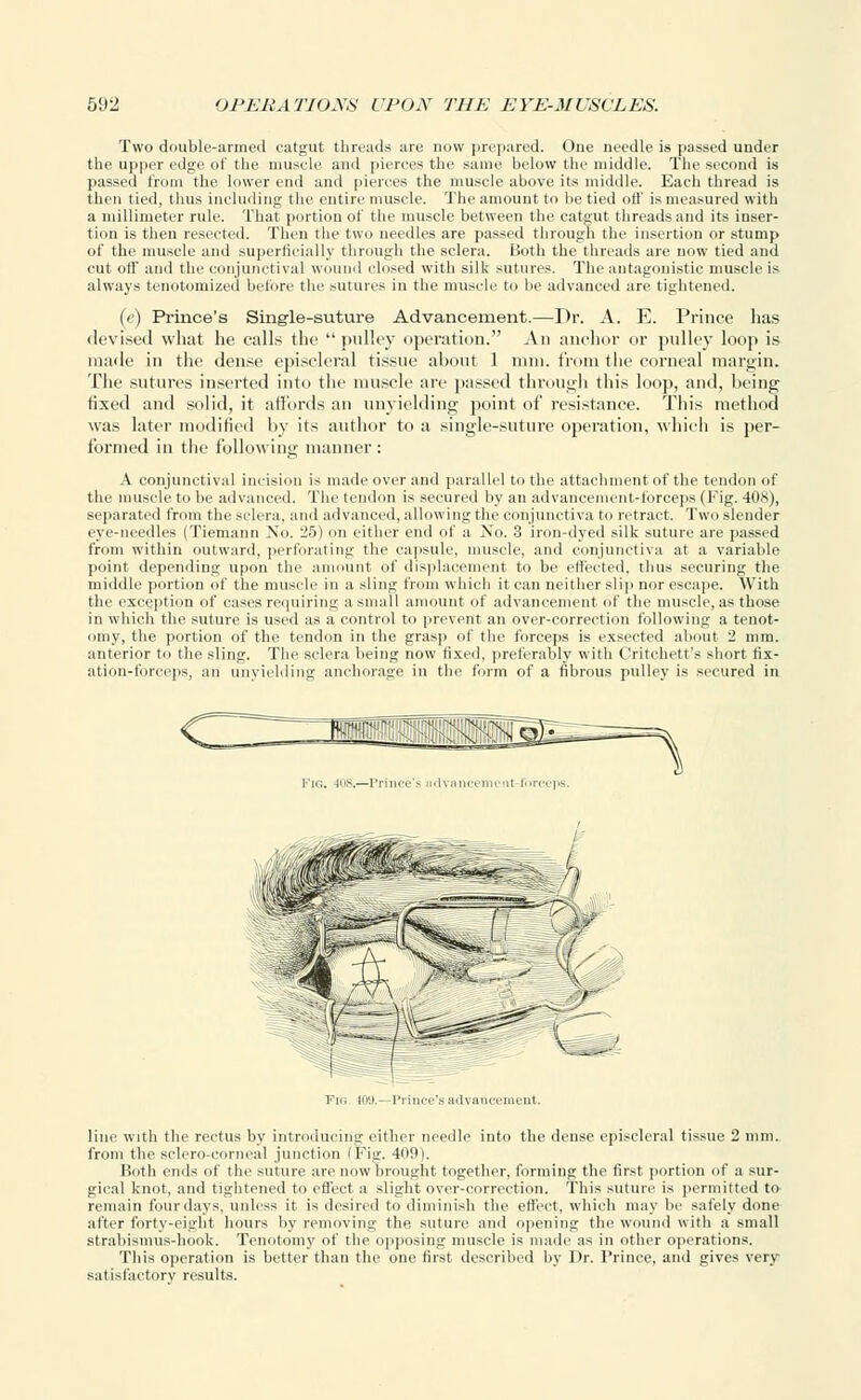 Two double-armed catgut threads are now prepared. One needle is passed under the upper edge of the muscle and pierces the same below the middle. The second is passed from the lower end and pierces the muscle above its middle. Each thread is then tied, thus including the entire muscle. The amount to be tied off is measured with a millimeter rule. That portion of the muscle between the catgut threads and its inser- tion is then resected. Then the two needles are passed through the insertion or stump of the muscle and superficially through the sclera. Both the threads are now tied and cut off and the conjunctival wound closed with silk sutures. The antagonistic muscle is always tenotomized before the sutures in the muscle to be advanced are tightened. (e) Prince's Single-suture Advancement.—Dr. A. E. Prince has devised what he calls the pulley operation. An anchor or pulley loop is made in the dense episcleral tissue about 1 mm. from the corneal margin. The sutures inserted into the muscle are passed through this loop, and, being fixed and solid, it affords an unyielding point of resistance. This method was later modified by its author to a single-suture operation, which is per- formed in the following manner : A conjunctival incision is made over and parallel to the attachment of the tendon of the muscle to be advanced. The tendon is secured by an advancement-forceps (Fig. 408), separated from the sclera, and advanced, allowing the conjunctiva to retract. Two slender eye-needles (Tiemann No. 25) on either end of a No. 3 iron-dyed silk suture are passed from within outward, perforating the capsule, muscle, and conjunctiva at a variable point depending upon the amount of displacement to be effected, thus securing the middle portion of the muscle in a sling from which it can neither slip nor escape. With the exception of cases requiring a small amount of advancement of the muscle, as those in which the suture is used as a control to prevent an over-correction following a tenot- omy, the portion of the tendon in the grasp of the forceps is exsected about 2 mm. anterior to the sling. The sclera being now fixed, preferably with Critchett's short fix- ation-forceps, an unyielding anchorage in the form of a fibrous pulley is secured in Fig KW.—Prince's advancement. line with the rectus by introducing either needle into the dense episcleral tissue 2 mm. from the sclero-corneal junction (Fig. 409). Both ends of the suture arc now brought together, forming the first portion of a sur- gical knot, and tightened to effect a slight over-correction. This suture is permitted to remain four days, unless it is desired to diminish the effect, which may be safely done after forty-eight hours by removing the suture and opening the wound with a small strabismus-hook. Tenotomy of the opposing muscle is made as in other operations. This operation is better than the one first described by Dr. Prince, and gives vei \ satisfactory results.