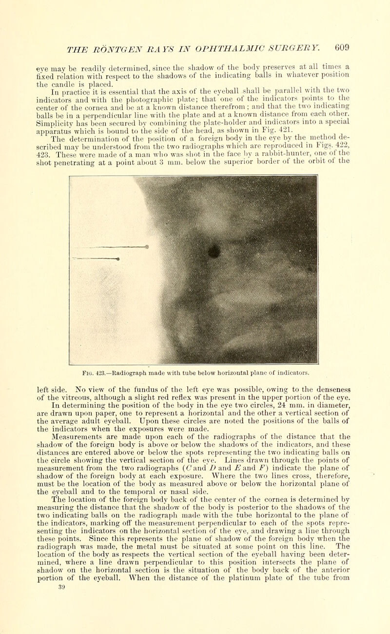 eye may be readily determined, since the shadow of the body preserves at all times a fixed relation with respect to the shadows of the indicating balls in whatever position ential that the axis of the eyeball shall be parallel with the two >hic plate; that one of the indicators points to the lown distance therefrom; and that the two indicating th the plate and at a known distance from each other. nbining the plate-holder and indicators into a special de of the head, as shown in Fig. 421. The determination of the position of a foreign body in the eye by the method de- scribed may be understood from the two radiographs which are reproduced in Figs. 422, 423. These were made of a man who was shot in the face by a rabbit-hunter, one of the shot penetrating at a point about 3 mm. below the superior border of the orbit of the In practice it is essi indicators and with the photi center of the cornea and be at balls be in a perpendicular lin Simplicity has been secured bj apparatus which is bound to th Fig. 423.—Radiograph made with tube below horizontal plane of indicators. left side. No view of the fundus of the left eye was possible, owing to the denseness of the vitreous, although a slight red reflex was present in the upper portion of the eye. In determining the position of the body in the eye two circles, 24 mm. in diameter, are drawn upon paper, one to represent a horizontal and the other a vertical section of the average adult eyeball. Upon these circles are noted the positions of the balls of the indicators when the exposures were made. Measurements are made upon each of the radiographs of the distance that the shadow of the foreign body is above or below the shadows of the indicators, and these distances are entered above or below the spots representing the two indicating balls on the circle showing the vertical section of the eye. Lines drawn through the points of measurement from the two radiographs (C'and I) and E and F) indicate the plane of shadow of the foreign body at each exposure. Where the two lines cross, therefore, must be the location of the body as measured above or below the horizontal plane of the eyeball and to the temporal or nasal side. The location of the foreign body back of the center of the cornea is determined by measuring the distance that the shadow of the body is posterior to the shadows of the two indicating balls on the radiograph made with the tube horizontal to the plane of the indicators, marking off the measurement perpendicular to each of the spots repre- senting the indicators on the horizontal section of the eye, and drawing a line through these points. Since this represents the plane of shadow of the foreign body when the radiograph was made, the metal must be situated at some point on this line. The location of the body as respects the vertical section of the eyeball having been deter- mined, where a line drawn perpendicular to this position intersects the plane of shadow on the horizontal section is the situation of the body back of the anterior portion of the eyeball. When the distance of the platinum plate of the tube from 39