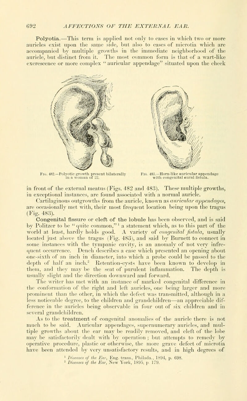 Polyotia.—This term is applied not only to eases in which two or more auricles exist upon the same side, but also to cases of microtia which are accompanied by multiple growths in the immediate neighborhood of the auricle, Imt distinct from it. The most common form is that of a wart-like excrescence or more complex  auricular appendage situated upon the cheek Fig. 483.—Horn-like auricular appendage with congenital aural fistula. in front of the external meatus (Figs. 482 and 483). These multiple growths, in exceptional instances, are found associated with a normal auricle. Cartilaginous outgrowths from the auricle, known as auricular appendages, are occasionally met with, their most frequent location being upon the tragus (Fig. 483). Congenital fissure or cleft of the lobule has been observed, and is said by Politzer to be  quite common,' a statement which, as to this part of the world at least, hardly holds good. A variety of congenital fistula, usually located just above the tragus (Fig. 483), and said by Burnett to connect in some instances with the tympanic cavity, is an anomaly of not very infre- quent occurrence. Dench describes a ease which presented an opening about one-sixth of an inch in diameter, into which a probe could be passed to the depth of half an inch.2 Retention-cysts have been known to develop in them, and they may be the seat of purulent inflammation. The depth is usually slight and the direction downward and forward. The writer has met with an instance of marked congenital difference in the conformation of the right and left auricles, one being larger and more prominent than the other, in which the defect was transmitted, although in a less noticeable degree, to the children and grandchildren—an appreciable dif- ference in the auricles being observable in four out of six children and in several grandchildren. As to the treatment of congenital anomalies of the auricle there is not much to be said. Auricular appendages, supernumerary auricles, and mul- tiple growths about the ear may be readily removed, and cleft of the lobe may be satisfactorily dealt with by operation ; but attempts to remedy by operative procedure, plastic or otherwise, the more grave defect of microtia have been attended by very unsatisfactory results, and in high degrees of 1 Diseases of the Ear, Eng. trans., Philada., 1894, p. 698. 2 Diseases of the Ear, New York, 1S95, p. 179.