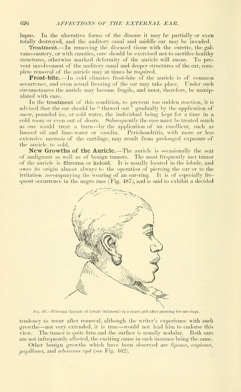 lupus. In the ulcerative forms of the disease it may be partially or even totally destroyed, and the auditory canal and middle ear may be invaded. Treatment.—In removing the diseased tissue with the curette, the gal- vano-cautery, or with caustics, care should be exercised not to sacrifice healthy structures, otherwise marked deformity of the auricle will ensue. To pre- vent involvement of the auditory canal and deeper structures of the ear, com- plete removal of the auricle may at times be required. Frost-bite.—In cold climates frost-bite of the auricle is of common occurrence, and even actual freezing of the car may take place. Under such circumstances the auricle may become fragile, and must, therefore, be manip- ulated with care. In the treatment of this condition, to prevent too sudden reaction, it is advised that the ear should be  thawed out  gradually by the application of snow, pounded ice, or cold water, the individual being kept for a time in a cold room or even out of doors. Subsequently the case must be treated much as one would treat a burn—by the application of an emollient, such as linseed oil and lime-water or vaselin. Perichondritis, with more or less extensive necrosis of the cartilage, may result from prolonged exposure of the auricle to cold. New Growths of the Auricle.—The auricle is occasionally the seat of malignant as well as of benign tumors. The most frequently met tumor of the auricle is fibroma or keloid. It is usually located in the lobule, and owes its origin almost always to the operation of piercing the car or to the irritation accompanying the wearing of an ear-ring. It is of especially fre- quent occurrence in the negro race (Fig. 487), and is said to exhibit a decided Fig. 487.—Fibroma (keloid) of lobule (bilateral) in a negro girl after piercing for ear-rings. tendency to recur after removal, although the writer's experience with such growths—not very extended, it is true—would not lead him to endorse this view. The tumor is quite firm and the surface is usually nodular. Both ears are not infrequently affected, the exciting cause in each instance being the same. Other benign growths which have been observed are lipoma, angioma, •papilloma, and sebaceous cyst (see Fig. 462).