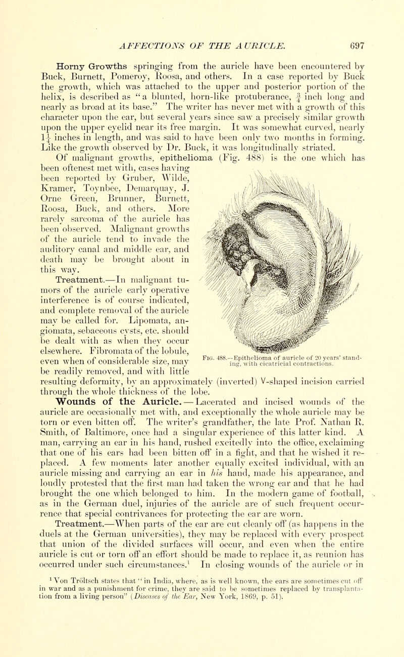 Horny Growths springing from the auricle have been encountered by Buck, Burnett, Pomeroy, Roosa, and others. In a case reported by Buck the growth, which was attached to the upper and posterior portion of the helix, is described as  a blunted, horn-like protuberance, f inch long and nearly as broad at its base. The writer has never met with a growth of this character upon the ear, but several years since saw a precisely similar growth upon the upper eyelid near its free margin. It was somewhat curved, nearly 1-L inches in length, and was said to have been only two months in forming. Like the growth observed by Dr. Buck, it was longitudinally striated. Of malignant growths, epithelioma (Fig. 488) is the one which has been oftenest met with, cases having been reported by Gruber, ^'ilde, Kramer, Toynbee, Demarquay, J. Orne Green, Brunner, Burnett, Roosa, Buck, and others. More rarely sarcoma of the auricle has been observed. Malignant growths of the auricle tend to invade the auditory canal and middle ear, and death may be brought about in this way. Treatment.—In malignant tu- mors of the auricle early operative interference is of course indicated, and complete removal of the auricle may be called for. Lipomata, an- giomata, sebaceous cysts, etc. should be dealt with as when they occur elsewhere. Fibromata of the lobule, even when of considerable size, may be readily removed, and with little resulting deformity, by an approximately (inverted) V-shaped incision carried through the whole thickness of the lobe. Wounds of the Auricle.—Lacerated and incised wounds of the auricle are occasionally met with, and exceptionally the whole auricle may be torn or even bitten off. The writer's grandfather, the late Prof. Nathan R. Smith, of Baltimore, once had a singular experience of this latter kind. A man, carrying an ear in his hand, rushed excitedly into the office, exclaiming that one of his ears had been bitten off in a fight, and that he wished it re- placed. A few moments later another equally excited individual, with an auricle missing and carrying an ear in his hand, made his appearance, and loudly protested that the first man had taken the wrong ear and that he had brought the one which belonged to him. In the modern game of football, as in the German duel, injuries of the auricle are of such frequent occur- rence that special contrivances for protecting the ear are worn. Treatment.—When parts of the ear are cut cleanly off (as happens in the duels at the German universities), they may be replaced with every prospect that union of the divided surfaces will occur, and even when the entire auricle is cut or torn off an effort should be made to replace it, as reunion has occurred under such circumstances.1 In closing wounds of the auricle or in 'Von Trbltsch states that  in India, where, as is well known, the ears are sometimes cut off in war and as a punishment for crime, they are said to be sometimes replaced by transplanta- tion from a living person [Diseases of the Ear, New York, 1869, p. 51).