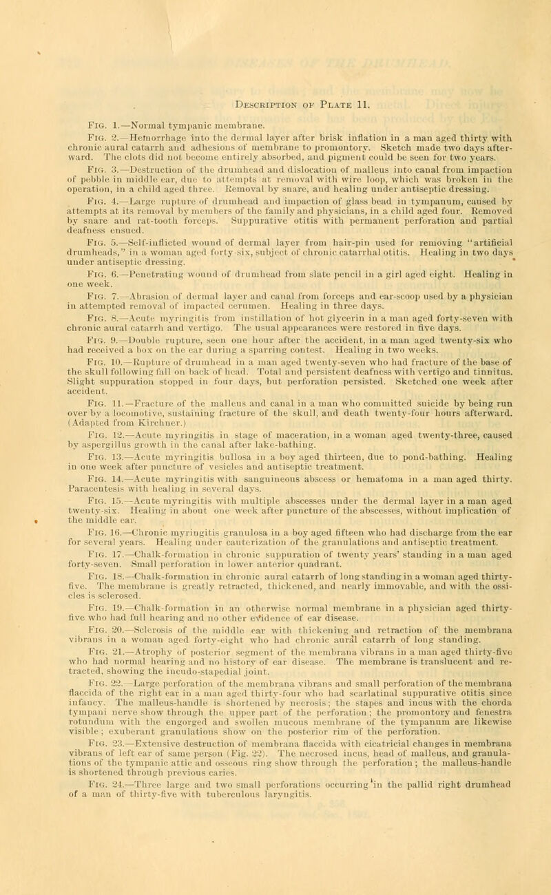 Description of Plate 11. Fig. 1.—Normal tympanic membrane. Fig. 2.—Hemorrhage into the dermal layer after brisk inflation in a man aged thirty with chronic aural catarrh and adhesions of membrane to promontory. Sketch made two days after- ward. The clots did not become entirely absorbed, and pigment could be seen for two years. Fn;. 3.—Destruction of the drumhead and dislocation of malleus into canal from impaction of pebble in middle ear, due 1 attempts at removal with wire loop, which was broken in the operation, in a child aged tbree. Removal by snare, and healing under antiseptic dressing. Fig. i.—Large rupture of drumhead and impaction of glass bead in tympanum, caused by attempts at its removal by members of the family and physicians, in a child aged four. Removed by snare and rat-tooth forceps. Suppurative otitis with permanent perforation and partial deafness ensued. Fig. 5.—Self-inflicted wound of dermal layer from hair-pin used for removing artificial drumheads,'' in a woman aged forty-six, subject of chronic catarrhal otitis. Healing in two days under antiseptic dressing. Fig. (!. — Penetrating wound of drumhead from slate pencil in a girl aged eight. Healing in one week. Fig. 7.—Abrasion of dermal layer anil canal from forceps and ear-scoop used by a physician in attempted removal of impacted cerumen. Healing in three days. Fig. 8.—Acute myringitis from instillation of hot glycerin in a man aged forty-seven with chronic aural catarrh and vertigo. The usual appearances were restored in five days. Fig. B. — Double rupture, seen one hour after the accident, in a man aged twenty-six who had received a box on the ear during a sparring contest. Healing in two weeks. Fig. 10.—Rupture of drumhead in a man aged twenty-seven who had fracture of the base of the skull following fall on back of head. Total and persistent, deafness with vertigo and tinnitus. Slight suppuration stopped in four days, but perforation persisted. Sketched one week alter accident. Fig. 11.—Fracture of the malleus and canal in a man who committed suicide by being run over by a locomotive, sustaining fracture of the skull, and death twenty-four hours afterward. (Adapted from Kirchner.) Fig. 12.—Acute myringitis in stage of maceration, in a woman aged twenty-three, caused by aspergillus growth in the canal after lake-bathing. Fig. 13.—Acute myringitis bullosa in a boy aged thirteen, due to pond-bathing. Healing in one week after puncture of vesicles and antiseptic treatment. Fig. 14.—Acute myringitis with sanguineous abscess or hematoma in a managed thirty. Paracentesis with healing in several days, FlG. 15. Acute myringitis with multiple abscesses under the dermal layer in a man aged twenty-six. Healing in about one week after puncture of the abscesses, without implication of the middle ear. Fig. 16.—Chronic myringitis granulosa in a boy aged fifteen who had discharge from the ear for several years. Healing under cauterization of the granulations and antiseptic treatment. Fig. 17.—Chalk-formatiou in chronic suppuration of twenty years' standing in a man aged forty-seven. Small perforation in lower anterior quadrant. FlG. 18.—Chalk-formation in chronic aural catarrh of longstanding in a woman aged thirty- five. The membrane is greatly retracted, thickened, and nearly immovable, and with the ossi- cles is sclerosed, Fig. 19.—Chalk-formation in an otherwise normal membrane in a physician aged thirty- five who had full hearing and no other evidence of ear disease. Fig. 20.—Sclerosis of the middle ear with thickening and retraction id' the membrana vibrans in a woman aged forty-eight who had chronic aural catarrh of long standing. FlG. 21.—Atrophy of posterior segment of the membrana vibrans in a man aged thirty-five who had normal hearing and no history of ear disease. The membrane is translucent aud re- tracted, showing the incudo-stapedial joint. Fig. 22.—Large perforation of the membrana vibrans and small perforation of the membrana Baccida of the right ear in a oiai aged thirty-four who had scarlatinal suppurative otitis since infancy. The malleus-handle is shortened by necrosis; the stapes and incus with the chorda tympani nerve show through the upper part of the perforation; the promontory aud fenestra rotundum with the engorged and swollen mucous membrane of the tympanum are likewise visible: exuberant granulations show <n\ the posterior rim of the perforation. FlG. 23.—Extensive destruction of membrana flaccida with cicatricial changes in membrana vibrans of bit ear of same person (Fig. 22). The necrosed incus, head of malleus, aud granula- tions of the tympanic attic aud osseous ring show through the perforation; the malleus-handle is shortened through previous caries. Fig. 24.—Three large and two small perforations occurring.'in the pallid right drumhead of a man of thirty-live with tuberculous laryngitis.