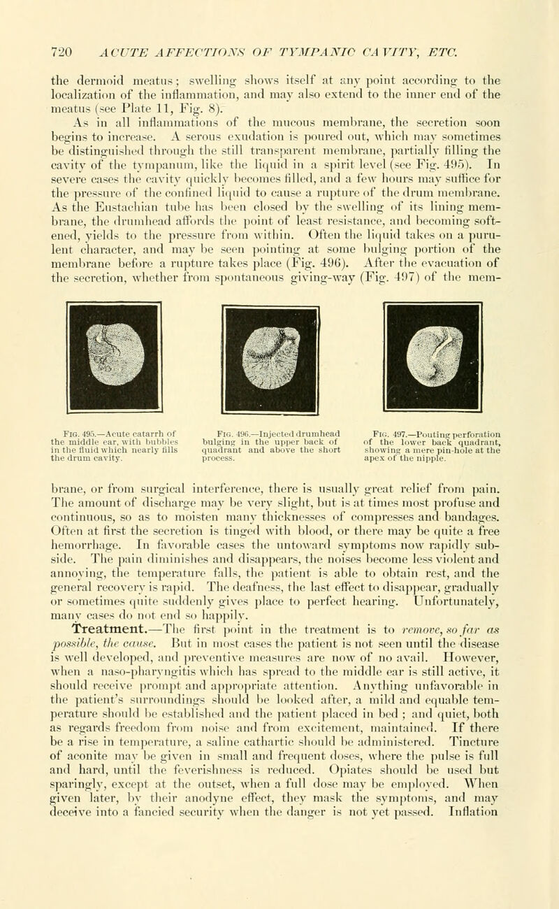 the dermoid meatus; swelling shows itself at any point according' to the localization of the inflammation, and may also extend to the inner end of the meatus (see Plate 11, Fig. 8). As in all inflammations of the mucous membrane, the secretion soon begins to increase. A serous exudation is poured out, which may sometimes be distinguished through the still transparent membrane, partially rilling the cavity of the tympanum, like the liquid in a spirit level (see Fig. 495). In severe cases the cavity quickly becomes filled, and a few hours may suffice for the pressure of the confined liquid to cause a rupture of the drum membrane. As the Eustachian tube has been closed by the swelling of its lining mem- brane, the drumhead affords the point of least resistance, and becoming soft- ened, yields to the pressure from within. Often the liquid takes on a puru- lent character, and may be seen pointing at some bulging portion of the membrane before a rupture takes place (Fig. 496). After the evacuation of the secretion, whether from spontaneous giving-w-ay (Fig. 497) of the mem- Fig. 495.—Acute catarrh of the middle car, with hubbies in the fluid which nearly tills the drum cavity. Fig. 496.—Injected drumhead bulging in the upper back <>f quadrant and above the short process. Flo. 497.—Pouting perforation of the lower back quadrant, showing a mere pin-hole at the apex of the nipple. brane, or from surgical interference, there is usually great relief from pain. The amount of discharge may be very slight, but is at times most profuse and continuous, so as to moisten many thicknesses of compresses and bandages. Often at first the secretion is tinged with blood, or there may be quite a free hemorrhage. In favorable cases the untoward symptoms now rapidly sub- side. The pain diminishes and disappears, the noises become less violent and annoying, the temperature falls, the patient is able to obtain rest, and the general recovery is rapid. The deafness, the last effect to disappear, gradually or sometimes quite suddenly gives place to perfect hearing. Unfortunately, many cases do not end so happily. Treatment.—The first point in the treatment is to remove, so far as possible, the cause. But in most cases the patient is not seen until the disease is well developed, and preventive measures are now of no avail. However, when a naso-pharyngitis which litis spread to the middle ear is still active, it should receive prompt and appropriate attention. Anything unfavorable in the patient's surroundings should lie looked after, a mild and equable tem- perature should l>e established and the patient placed in bed ; and quiet, both as regards freedom from noise and from excitement, maintained. If there be a rise in temperature, a saline cathartic should be administered. Tincture of aconite may be given in small and frequent doses, where the pulse is full and hard, until the feverishness is reduced. Opiates should be used but sparingly, except at the outset, when a full dose may be employed. When given later, by their anodyne effect, they mask the symptoms, and may deceive into a fancied security when the danger is not yet passed. Inflation