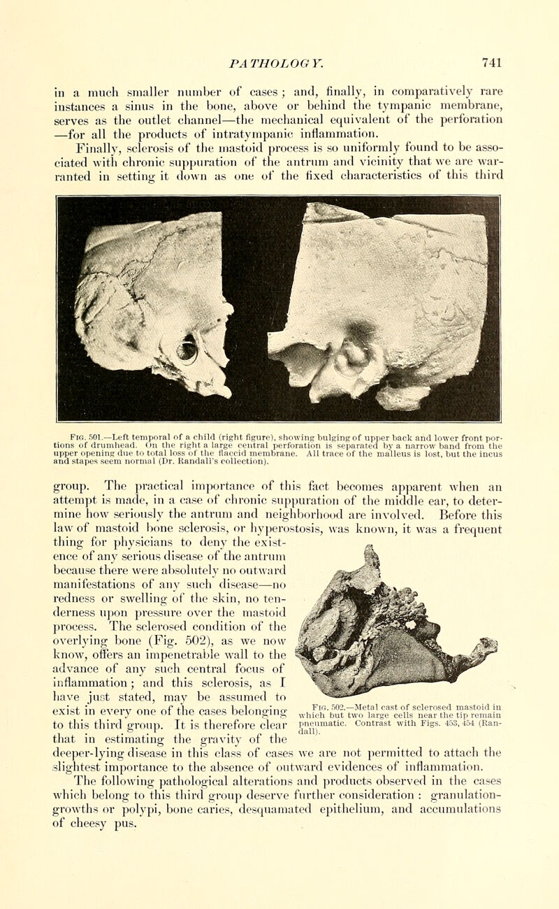 in a much smaller number of cases ; and, finally, in comparatively rare instances a sinus in the bone, above or behind the tympanic membrane, serves as the outlet channel—the mechanical equivalent of the perforation —for all the products of intratympanic inflammation. Finally, sclerosis of the mastoid process is so uniformly found to be asso- ciated with chronic suppuration of the antrum and vicinity that we are war- ranted in setting it down as one of the fixed characteristics of this third Fig. 501.—Left temporal of a child (right figure), showing bulgingof upper back and lower front por- tions of drumhead. On the right a large central perforation is separated by a narrow band from the upper opening due to total loss of the flaccid membrane. All trace of the malleus is lost, but the incus and stapes seem normal (Dr. Randall's collection). group. The practical importance of this fact becomes apparent when an attempt is made, in a case of chronic suppuration of the middle ear, to deter- mine how seriously the antrum and neighborhood are involved. Before this law of mastoid bone sclerosis, or hyperostosis, was known, it was a frequent thing for physicians to deny the exist- ence of any serious disease of the antrum because there were absolutely no outward manifestations of any such disease—no redness or swelling of the skin, no ten- derness upon pressure over the mastoid process. The sclerosed condition of the overlying bone (Fig. 502), as we now know, offers an impenetrable wall to the advance of any such central focus of inflammation; and this sclerosis, as I have just stated, may be assumed to exist in every one of the cases belonging to this third group. It is therefore clear that in estimating the gravity of the deeper-lying disease in this class of cases we are not permitted to attach the slightest importance to the absence of outward evidences of inflammation. The following pathological alterations and products observed in the cases which belong to this third group deserve further consideration : granulation- growths or polypi, bone caries, desquamated epithelium, and accumulations of cheesy pus. Fig. 50~—Metal cast of sclerosed mastoid in which but two large cells near the tip remain pneumatic. Contrast with Figs. -I'vl, 454 (Ran- dall).