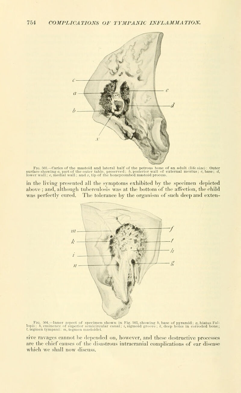 Fig. 503.—Caries of the mastoid and lateral half of the petrous bone of an adult (life size): Outer surface showing a. part of the outer table, preserved; b, posterior wall of external meatus; c, base; d, lower wall; e, medial wall; and xt tip of the honeycombed mastoid process. in the living presented all the symptoms exhibited by the specimen depicted above ; and, although tuberculosis was at the bottom of the affection, the child was perfectly cured. The tolerance by the organism of such deep and exten- Fig. 504.—Inner aspect of specimen shown in Fig. r>03, show ire.' '-.base of pyramid; <7, hiatus Fal- lopii: A, eminence of superior semicircular canal; /.sigmoid groove; k, deep holes in corroded bone; I. tegmen tympani: m, tegmen mastoidei. sive ravages cannot be depended on, however, and these destructive processes are the chief causes of the disastrous intracranial complications of ear disease which we shall now discuss.