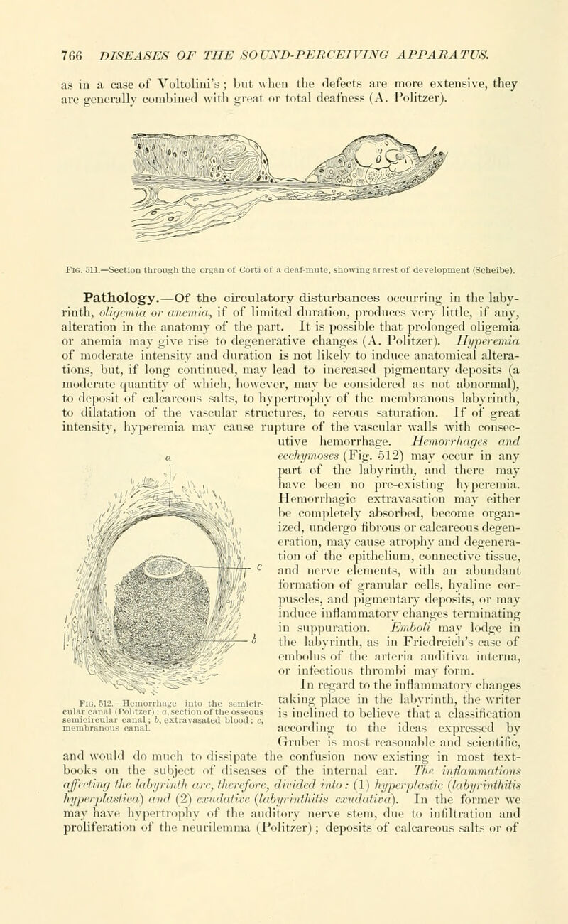 as in a case of Voltolini's; but when the defects are more extensive, they are generally combined with great or total deafness (A. Politzer). Fig. 511.—Section through the organ of Corti of a deaf-mute, showing arrest of development (Scheibe). V, Pathology.—Of the circulatory disturbances occurring in the laby- rinth, oligemia or anemia, if of limited duration, produces very little, if any, alteration in the anatomy of the part. It is possible that prolonged oligemia or anemia may give l'ise to degenerative changes (A. Politzer). Hyperemia of moderate intensity and duration is not likely to induce anatomical altera- tions, but, if long continued, may lead to increased pigmentary deposits (a moderate quantity of which, however, may be considered as not abnormal), to deposit of calcareous salts, to hypertrophy of the membranous labyrinth, to dilatation of the vascular structures, to serous saturation. If of great intensity, hyperemia may cause rupture of the vascular walls with consec- utive hemorrhage. Hemorrhages and a. cechymoses (Fig. 512) may occur in any part of the labyrinth, and there may have been no pre-existing hyperemia. Hemorrhagic extravasation may either be completely absorbed, become organ- ized, undergo fibrous or calcareous degen- eration, may cause atrophy ami degenera- tion of the epithelium, connective tissue, and nerve elements, with an abundant formation of granular cells, hyaline cor- puscles, and pigmentary deposits, or may induce inflammatory changes terminating in suppuration. Emboli may lodge in the labyrinth, as in Friedreich's case of embolus of the arteria auditiva interna, or infectious thrombi may form. In regard to the inflammatory changes taking place in the labyrinth, the writer is inclined to believe that a classification according to the ideas expressed by Gruber is most reasonable and scientific, and would do much to dissipate the confusion now existing in most text- books on the subject of diseases of the internal ear. The. inflammations affecting the labyrinth arc, then fore, divided into: (11 hyperplastic (labyrinthitis hyperplastica) and (2) exudative labyrinthitis exudativa). In the former we may have hypertrophy of the auditory nerve stem, due to infiltration and proliferation of the neurilemma (Politzer); deposits of calcareous salts or of 6 Fig. 512.—Hemorrhage into the cular canal (Politzer) : a,section of the osseous semicircular canal; b, extravasated blood; <; membranous canal.