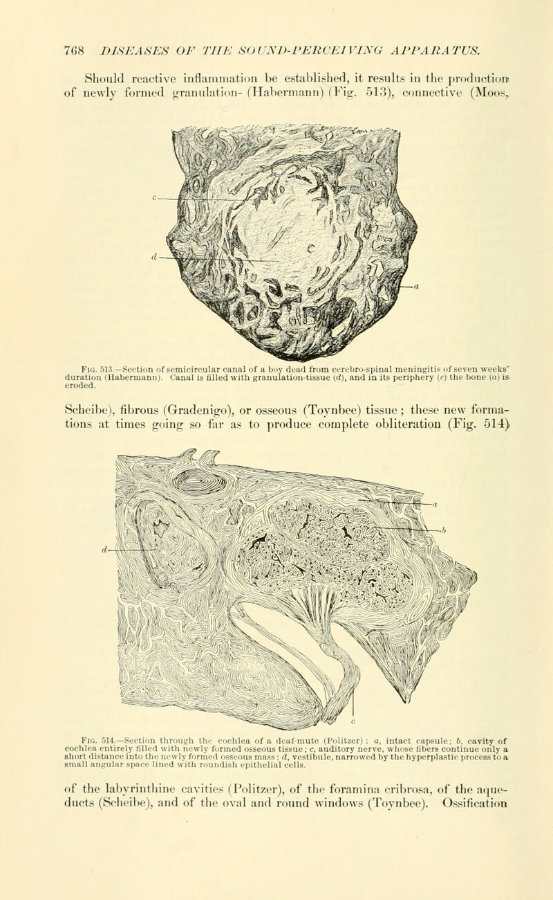 Should reactive inflammation be established, it results in the production of newly formed granulation- (Habermann) (Fig. 513), connective (Moos, Fig. 513.—Section of semicircular canal of a boy dead from cerebrospinal meningitis of seven weeks' duration (Habermann). Canal is filled with granulation-tissue (d), and in its periphery (c) the bone taj is eroded. Scheibe), fibrous (Gradenigo), or osseous (Tovnbee) tissue ; these new forma- tions at times going so far as to produce complete obliteration (Fig. 514) ■ y'^;' > Fig. 514.—Section through the cochlea of a deaf-mute (Politzer) ; a, intact capsule; b, cavity of cochlea entirely rilled with newly farmed osseous tissue; c, auditory nerve, whose fibers continue only a short distance into t hi- newly formed nsscous mass ; d, vestibule, narrowed by the hyperplastic process to a small angular space lined with roundish epithelial cells. of the labyrinthine cavities (Politzer), of the foramina cribrosa, of the aque- ducts (Scheibe), and of the oval and round windows (Toynbee). Ossification