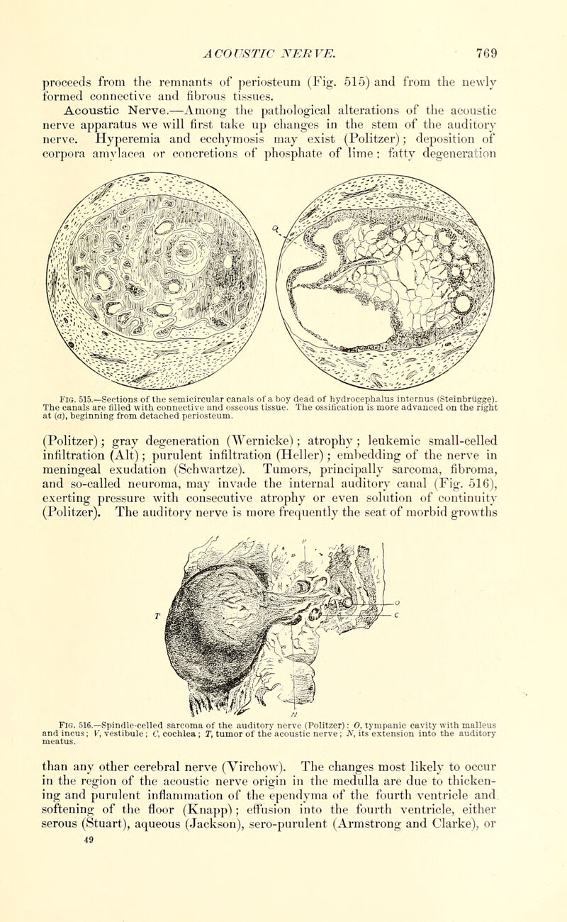 proceeds from the remnants of periosteum (Fig. 515) and from the newly formed connective and fibrous tissues. Acoustic Nerve.—Among the pathological alterations of the acoustic nerve apparatus we will first take up changes in the stem of the auditory nerve. Hyperemia and ecchymosis may exist (Politzer); deposition of corpora amylacea or concretions of phosphate of lime : fatty degeneration Fig. 515.—Sections of the semicircular canals of a boy dead of hydrocephalus internus (Steinbriigge). The canals are filled with connective and osseous tissue. The ossification is more advanced on the right at (a), beginning from detached periosteum. (Politzer); gray degeneration (Wernicke); atrophy ; leukemic small-celled infiltration (Alt); purulent infiltration (Heller); embedding of the nerve in meningeal exudation (Schwartze). Tumors, principally sarcoma, fibroma, and so-called neuroma, may invade the internal auditory canal (Fig. 516), exerting pressure with consecutive atrophy or even solution of continuity (Politzer). The auditory nerve is more frequently the seat of morbid growths Fig. 516.—Spindle-celled sarcoma of the auditory nerve (Politzer): 0, tympanic cavity with malleus and incus; V, vestibule; C, cochlea ; T, tumor of the acoustic nerve; ^V, its extension into the auditory meatus. than any other cerebral nerve (Virchow). The changes most likely to occur in the region of the acoustic nerve origin in the medulla are due to thicken- ing and purulent inflammation of the ependyma of the fourth ventricle and softening of the floor (Knapp); effusion into the fourth ventricle, either serous (Stuart), aqueous (Jackson), sero-purulent (Armstrong and Clarke), or