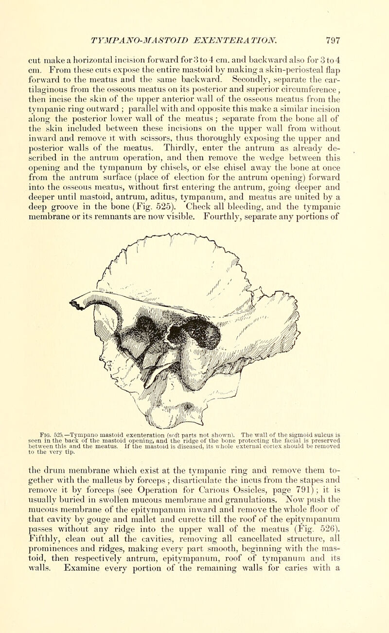 cut make a horizontal incision forward for.'3to4 cm. and backward also for 3to4 cm. From these cuts expose the entire mastoid by making a skin-periosteal flap forward to the meatus and the same backward. Secondly, separate the car- tilaginous from the osseous meatus on its posterior and superior circumference, then incise the skin of the upper anterior wall of the osseous meatus from the tympanic ring outward ; parallel with and opposite this make a similar incision along the posterior lower wall of the meatus; separate from the bone all of the skin included between these incisions on the upper wall from without inward and remove it with scissors, thus thoroughly exposing the upper and posterior walls of the meatus. Thirdly, enter the antrum as already de- scribed in the antrum operation, and then remove the wedge between this opening and the tympanum by chisels, or else chisel away the bone at once from the antrum surface (place of election for the antrum opening) forward into the osseous meatus, without first entering the antrum, going deeper and deeper until mastoid, antrum, aditus, tympanum, and meatus are united by a deep groove in the bone (Fig. 525). Check all bleeding, and the tympanic membrane or its remnants are now visible. Fourthly, separate any portions of (JS^Z Fig. 525. — Tynipanu mastoid exenteration (soft parts not shown). The wall of the sigmoid sulcus is seen in the hack of the mastoid opening, and the ridge of the bone protecting the facial is preserved between this and the meatus. If the mastoid is diseased, its whole external cortex should be removed to the very tip. the drum membrane which exist at the tympanic ring and remove them to- gether with the malleus by forceps ; disarticulate the incus from the stapes and remove it by forceps (see Operation for Carious Ossicles, page 791); it is usually buried in swollen mucous membrane and granulations. Now push the mucous membrane of the epitympanum inward and remove the whole floor of that cavity by gouge and mallet and curette till the roof of the epitympanum passes without any ridge into the upper wall of the meatus (Fig. 526). Fifthly, clean out all the cavities, removing all cancellated structure, all prominences and ridges, making every part smooth, beginning with the mas- toid, then respectively antrum, epitympanum, roof of tympanum and its walls. Examine every portion of the remaining walls for caries with a