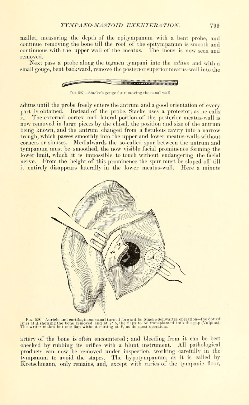 mallet, measuring the depth of the epitympanum with a bent probe, and continue removing the bone till the roof of the epitympanum is smooth and continuous with the upper wall of the meatus. The incus is now seen and removed. Next pass a probe along the tegmen tympani into the aditus and with a small gouge, bent backward, remove the posterior superior meatus-wall into the Fig. 527.—Stacke's gouge for removing the canal wall aditus until the probe freely enters the antrum and a good orientation of every part is obtained. Instead of the probe, Stacke uses a protector, as he calls it. The external cortex and lateral portion of the posterior meatus-wall is now removed in large pieces by the chisel, the position and size of the antrum being known, and the antrum changed from a fistulous cavity into a narrow trough, which passes smoothly into the upper and lower meatus-walls without corners or sinuses. Medial wards the so-called spur between the antrum and tympanum must be smoothed, the now visible facial prominence forming the lower limit, which it is impossible to touch without endangering the facial nerve. From the height of this prominence the spur must be sloped off till it entirely disappears laterally in the lower meatus-wall. Here a minute Fig. 528.—Auricle and cartilaginous canal turned forward for Stacke-Sehwartze operation—the dotted lines at A showing the hone removed, and at F, S, the flaps to be transplanted into the gap (Vulpius) The writer makes but one flap without cutting at P, as do most operators. artery of the bone is often encountered ; and bleeding from it can be best checked by rubbing its orifice with a blunt instrument. All pathological products can now be removed under inspection, working carefully in the tympanum to avoid the stapes. The hypotympanum, as it is called by Ivretschmann, only remains, and, except with caries of the tympanic floor,