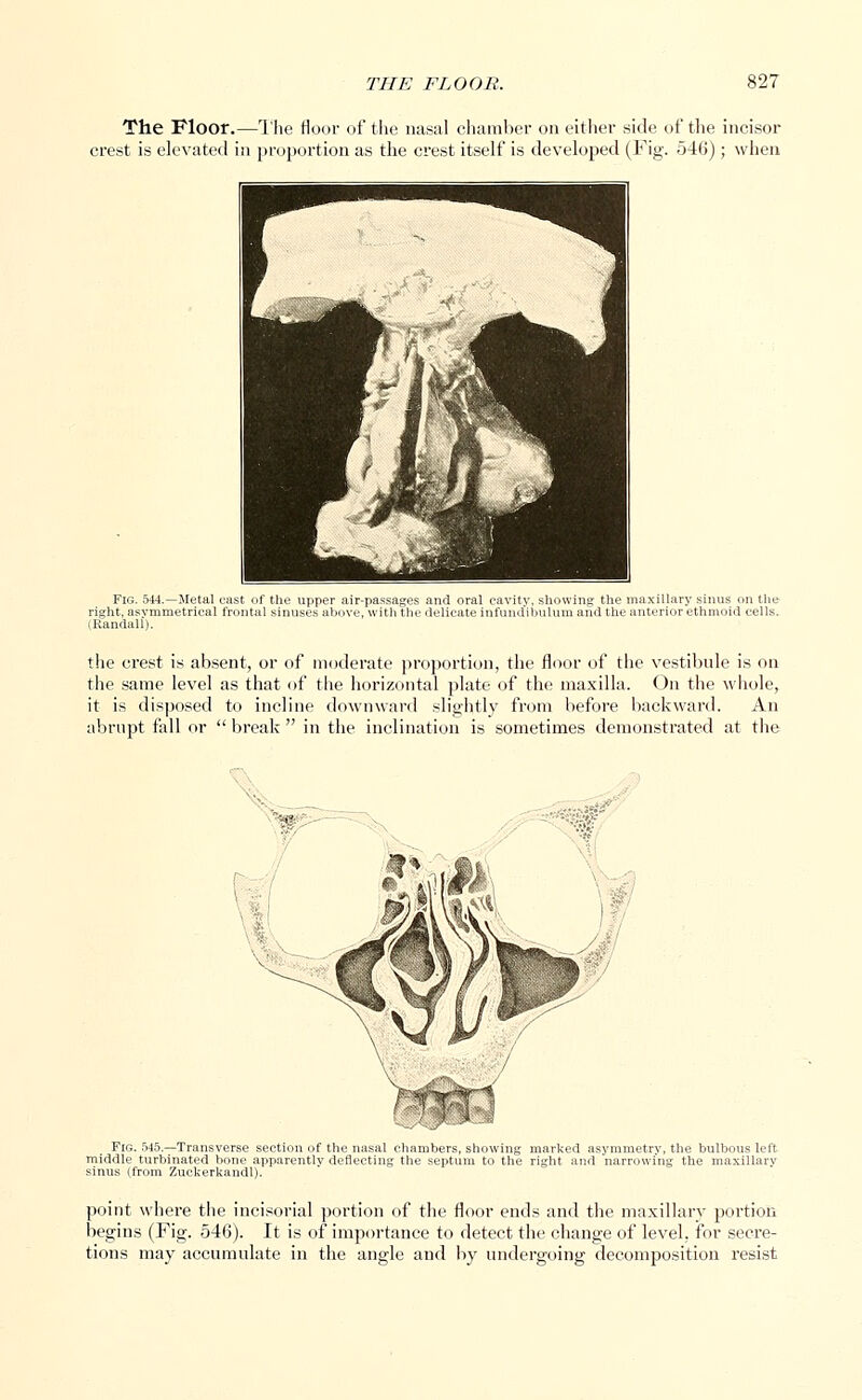 The Floor.—The floor of the nasal chamber on either side of the incisor crest is elevated in proportion as the crest itself is developed (Fig. 546'); when Fig. 544.—Metal east of the upper air-passages and oral cavity, showing the maxillary sinus on the right, asvmmetrieal frontal sinuses above, with tin- delicate in fundi Mil urn and (he anterior ethmoid cells. (Randall). the crest is absent, or of moderate proportion, the floor of the vestibule is on the same level as that of the horizontal plate of the maxilla. On the whole, it is disposed to incline downward slightly from before backward. An abrupt fall or  break  in the inclination is sometimes demonstrated at the Fig. 545.—Transverse section of the nasal chambers, showing marked asymmetry, the bulbous left middle turbinated bone apparently deflecting the septum to the right and narrowing the maxillarv sinus (from Zuckerkandl). point where the incisorial portion of the floor ends and the maxillarv portion begins (Fig. 546). It is of importance to detect the change of level, for secre- tions may accumulate in the angle and by undergoing decomposition resist