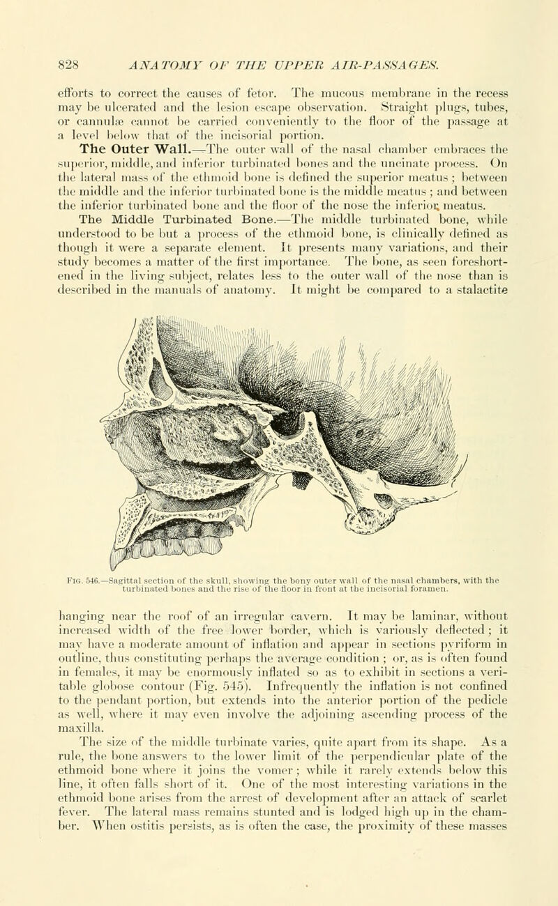 efforts to correct the causes of fetor. The mucous membrane in the recess may be ulcerated and the lesion escape observation. Straight plugs, tubes, or cannulae cannot be carried conveniently to the floor of the passage at a level below that of the incisorial portion. The Outer Wall.—The outer wall of the nasal chamber embraces the superior, middle,and inferior turbinated bones and the uncinate process. On the lateral mass of the ethmoid bone is defined the superior meatus ; between the middle and the inferior turbinated bone is the middle meatus ; and between the inferior turbinated bone and the floor of the nose the inferior, meatus. The Middle Turbinated Bone.—The middle turbinated bone, while understood to be but a process of the ethmoid bone, is clinically defined as though it were a separate element. It presents many variations, and their study becomes a matter of the first importance. The bone, as seen foreshort- ened in the living subject, relates less to the outer wall of the nose than io described in the manuals of anatomy. It might be compared to a stalactite hanging near the roof of an irregular cavern. It may be laminar, without increased width of the free lower border, which is variously deflected; it may have a moderate amount of inflation and appear in sections pyriform in outline, thus constituting perhaps the average condition ; or, as is often found in females, it may be enormously inflated so as to exhibit in sections a veri- table globose contour (Fig. 545). Infrequently the inflation is not confined to the pendant portion, but extends into the anterior portion of the pedicle as well, where it may even involve the adjoining ascending process of the maxilla. The size of the middle turbinate varies, quite apart from its shape. As a rule, the bone answers to the lower limit of the perpendicular plate of the ethmoid bone where it joins the vomer; while it rarely extends below this line, it often falls short of it. One of the most interesting variations in the ethmoid bone arises from the arrest of development after an attack of scarlet fever. The lateral mass remains stunted and is lodged high up in the cham- ber. When ostitis persists, as is often the case, the proximity of these masses