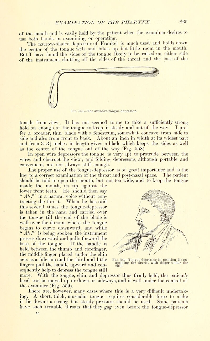 of the mouth and is easily held by the patient when the examiner desires to use both hands in examining or operating. The narrow-bladed depressor of Frankel is much used and holds down the center of the tongue well and takes up but little room in the mouth. But I have found the sides of the tongue likely to be raised on either side of the instrument, shutting off the sides of the throat and the base of the Fig. 558.—The author's tongue-depressor tonsils from view. It has not seemed to me to take a sufficiently strong hold on enough of the tongue to keep it steady and out of the way. I pre- fer a broader, thin blade with a fenestrum, somewhat concave from side to side and also from front to back. About an inch in width at its widest part and from 3-3.^- inches in length gives a blade which keeps the sides as well as the center of the tongue out of the way (Fig. 558). In open wire depressors the tongue is very apt to protrude between the wires and obstruct the view; and folding depressors, although portable and convenient, are not always stiff enough. The proper use of the tongue-depressor is of great importance and is the key to a correct examination of the throat and post-nasal space. The patient should be told to open the mouth, but not too wide, and to keep the tongue inside the mouth, its tip against the lower front teeth. He should then say  Ah ! in a natural voice without con- tracting the throat. When he has said this several times the tongue-depressor is taken in the hand and carried over the tongue till the end of the blade is well over the dorsum where the tongue begins to curve downward, and while  Ah ! is being spoken the instrument presses downward and pulls forward the base of the tongue. If the handle is held between the thumb and forefinger, the middle finger placed under the chin acts as a fulcrum and the third and little fingers pull the handle upward and con- sequently help to depress the tongue still more. With the tongue, chin, and depressor thus firmly held, the patient's head can be moved up or down or sideways, and is well under the control of the examiner (Fig. 559). There are, however, many cases where this is a very difficult undertak- ing. A short, thick, muscular tongue requires considerable force to make it lie down; a strong but steady pressure should be used. Some patients have such irritable throats that they gag even before the tongue-depressor iy. 559.—Tongue-depressor in position for ex- amining the fauces, with finger under the chin.