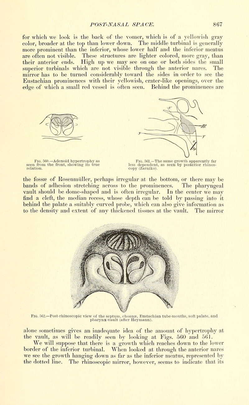 for which we look is the back of the vomer, which is of a yellowish gray color, broader at the top than lower down. The middle turbinal is generally more prominent than the inferior, whose lower half and the inferior meatus are often not visible. These structures are lighter colored, more gray, than their anterior ends. High up we may see on one or both sides the small superior turbinals which are not visible through the anterior nares. The mirror has to be turned considerably toward the sides in order to see the Eustachian prominences with their yellowish, crater-like openings, over the edge of which a small red vessel is often seen. Behind the prominences are Fig. 560.—Adenoid hypertrophy as seen from the front, showing its true relation. Fig. 561.—The same growth apparently far less dependent, as seen by posterior rhinos- copy (Zarniko). the fossae of Rosen miiller, perhaps irregular at the bottom, or there may be bands of adhesion stretching across to the prominences. The pharyngeal vault should be dome-shaped and is often irregular. In the center we may find a cleft, the median recess, whose depth can be told by passing into it behind the palate a suitably curved probe, which can also give information as to the density and extent of any thickened tissues at the vault. The mirror Fig. 562.—Post-rhinoscopic view of the septum, choanal, Eustachian tube-mouths, soft palate, and pharynx-vault (after Heymann). alone sometimes gives an inadequate idea of the amount of hypertrophy at the vault, as will be readily seen by looking at Figs. 560 and 561. We will suppose that there is a growth which reaches down to the lower border of the inferior turbinal. When looked at through the anterior nares we see the growth hanging down as far as the inferior meatus, represented by the dotted line. The rhinoscopic mirror, however, seems to indicate that its