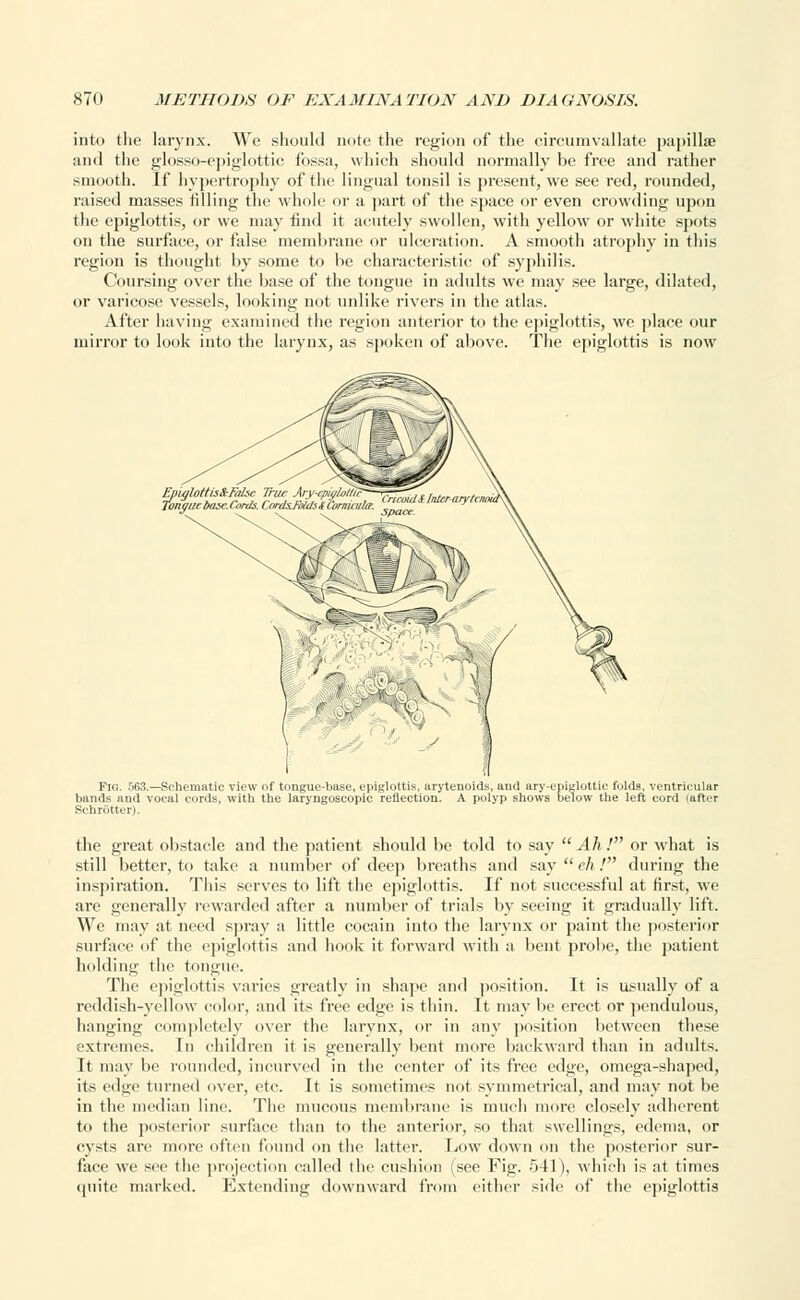 into the larynx. We should note the region of the circumvallate papilla? and the glosso-epiglottic fos.sa, which should normally be free and rather smooth. If hypertrophy of the lingual tonsil is present, we see red, rounded, raised masses filling the whole or a part of the space or even crowding upon the epiglottis, or we may find it acutely swollen, with yellow or white spots on the surface, or false membrane or ulceration. A smooth atrophy in this region is thought by some to be characteristic of syphilis. Coursing over the base of the tongue in adults we may see large, dilated, or varicose vessels, looking not unlike rivers in the atlas. After having examined the region anterior to the epiglottis, we place our mirror to look into the larynx, as .spoken of above. The epiglottis is now Fig. 563.—Schematic view of tongue-base, epiglottis, arytenoids, and ary-epiglottic folds, ventricular bands and vocal cords, with the laryngoscopy reflection. A polyp shows below the left cord (after Schrotter). the great obstacle and the patient should be told to say  Ah ! or what is still better, to take a number of deep breaths and say eh! during the inspiration. This serves to lift the epiglottis. If not successful at first, we are generally rewarded after a number of trials by seeing it gradually lift. We may at need spray a little cocain into the larynx or paint the posterior surface of the epiglottis and honk it forward with a bent probe, the patient holding the tongue. The epiglottis varies greatly in shape and position. It is usually of a reddish-yellow color, and its free edge is thin. It may be erect or pendulous, hanging completely over the larynx, or in any position between these extremes. In children it is generally bent more backward than in adidts. It may be rounded, incurved in the center of its free edge, omega-shaped, its edge turned over, etc. It is sometimes not symmetrical, and may not be in the median line. The mucous membrane is much more closely adherent to the posterior surface than to the anterior, so that swellings, edema, or cysts are more often found on the latter. Low down on the posterior sur- face we see the projection called the cushion (see Fig. 541), which is at times quite marked. Extending downward from either side of the epiglottis