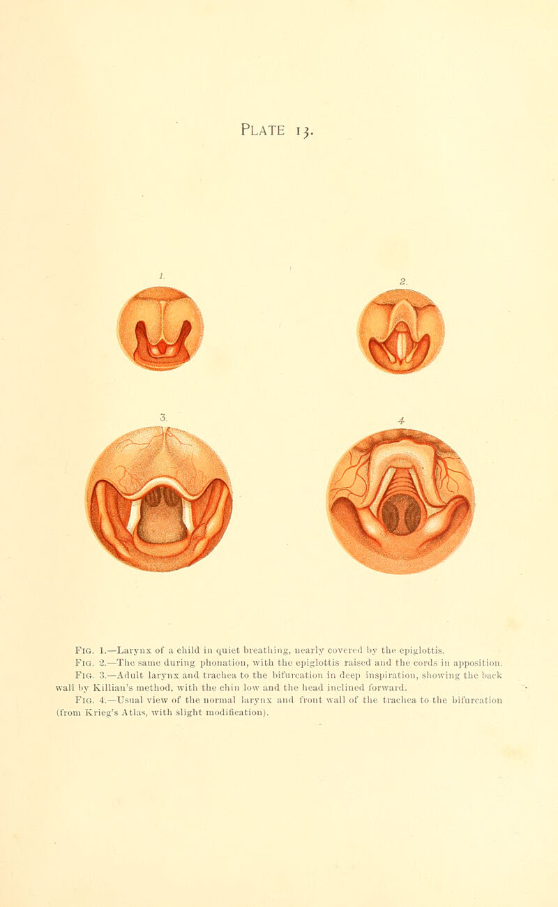 Plate 13. Fig. 1.—Larynx of a child ill quiet breathing, nearly covered by the epiglottis. Fig. 2.—The same during pronation, with the epiglottis raised and the cords in apposition. Fig. 3.—Adult larynx and trachea to the bifurcation in deep inspiration, showing the hack wall by Killian's method, with the chin low and the head inclined forward. Fig. 4.—Usual view of the normal larynx and front wall of the trachea to the bifurcation (from Krieg's Atlas, with slight modification).