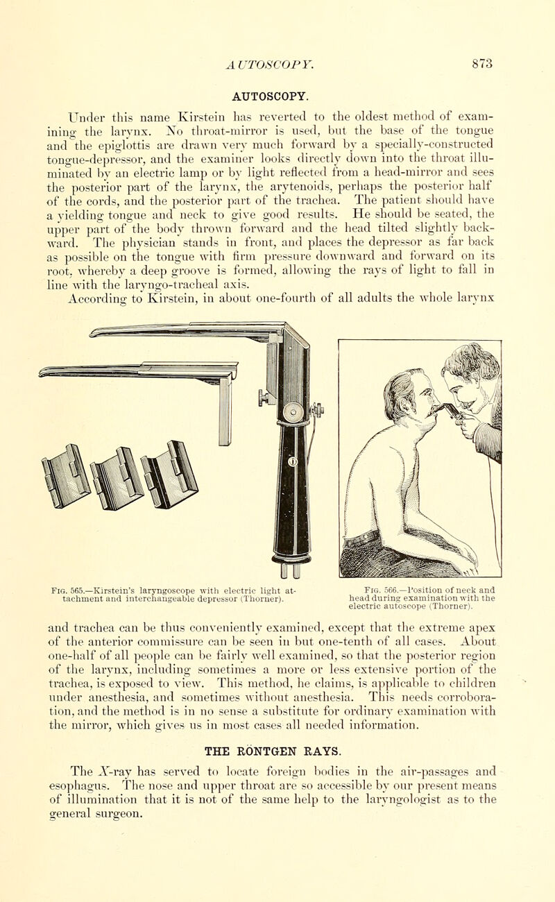 AUTOSCOPY. Under this name Kirstein has reverted to the oldest method of exam- ining the larynx. No throat-mirror is used, but the base of the tongue and the epiglottis are drawn very much forward by a specially-constructed tongue-depressor, and the examiner looks directly down into the throat illu- minated by an electric lamp or by light reflected from a head-mirror and sees the posterior part of the larynx, the arytenoids, perhaps the posterior half of the cords, and the posterior part of the trachea. The patient should have a yielding tongue and neck to give good results. He should be seated, the upper part of the body thrown forward and the head tilted slightly back- ward. The physician stands in front, and places the depressor as far back as possible on the tongue with firm pressure downward and forward on its root, whereby a deep groove is formed, allowing the rays of light to fall in line with the laryngotracheal axis. According to Kirstein, in about one-fourth of all adults the whole larynx Fig. 565.—Kjrstein's laryngoscope with electric light at- tachment, and interchangeable depressor (Thorner). Fig. 566.—Position of neck and head during examination with the electric autoseope (Thorner). and trachea can be thus conveniently examined, except that the extreme apex of the anterior commissure can be seen in but one-tenth of all cases. About one-half of all people can be fairly well examined, so that the posterior region of the larynx, including sometimes a more or less extensive portion of the trachea, is exposed to view. This method, he claims, is applicable to children under anesthesia, and sometimes without anesthesia. This needs corrobora- tion, and the method is in no sense a substitute for ordinary examination with the mirror, which gives us in most cases all needed information. THE RONTGEN RAYS. The A'-ray has served to locate foreign bodies in the air-passages and esophagus. The nose and upper throat are so accessible by our present means of illumination that it is not of the same help to the larvngologist as to the general surgeon.