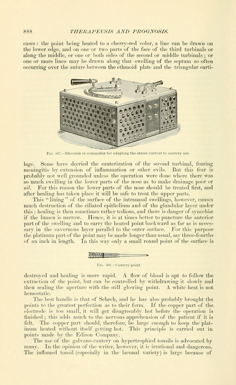 cases : the point being heated to a cherry-red color, a line can be drawn on the lower edge, and on one or two parts of the face of the third turbinals or along the middle, or one or both sides of the second or middle turbinals; or one or more lines may be drawn along that swelling of the septum so often occurring over the suture between the ethmoid plate and the triangular carti- 3J-?, Fig. 567.—Rheostat or coniuiutor for adapting the street current to cautery lage. Some have decried the cauterization of the second turbinal, fearing meningitis by extension of inflammation or other evils. But this fear is probably not well grounded unless the operation were done where there was so much swelling in the lower parts of the nose as to make drainage poor or nil. For this reason the lower parts of the nose should be treated first, and after healing has taken place it will be safe to treat the upper parts. This  lining  of the surface of the intranasal swellings, however, causes much destruction of the ciliated epithelium and of the glandular layer under this ; healing is then sometimes rather tedious, and there is danger of synechia? if the lumen is narrow. Hence, it is at times better to puncture the anterior part of the swelling and to carry the heated point backward as far as is neces- sary in the cavernous layer parallel to the outer surface. For this purpose the platinum part of the point may be made longer than usual, say three-fourths of an inch in length. In this way only a small round point of the surface is Fig. 568.—Cautery-point. destroyed and healing is more rapid. A flow of blood is apt to follow the extraction of the point, but can be controlled by withdrawing it slowly and then sealing the aperture with the still glowing point. A white heat is not hemostatic. The best handle is that of Schech, and he has also probably brought the points to the greatest perfection as to their form. If the copper part of the electrode is too small, it will get disagreeably hot before the operation is finished ; this adds much to the nervous apprehension of the patient if it is felt. The copper part should, therefore, be large enough to keep the plat- inum heated without itself getting hot. This principle is carried out in points made by the Edison Company. The use of the galvano-cautery on hypertrophied tonsils is advocated by many. In the opinion of the writer, however, it is irrational and dangerous. The inflamed tonsil (especially in the laeunal variety) is large because of