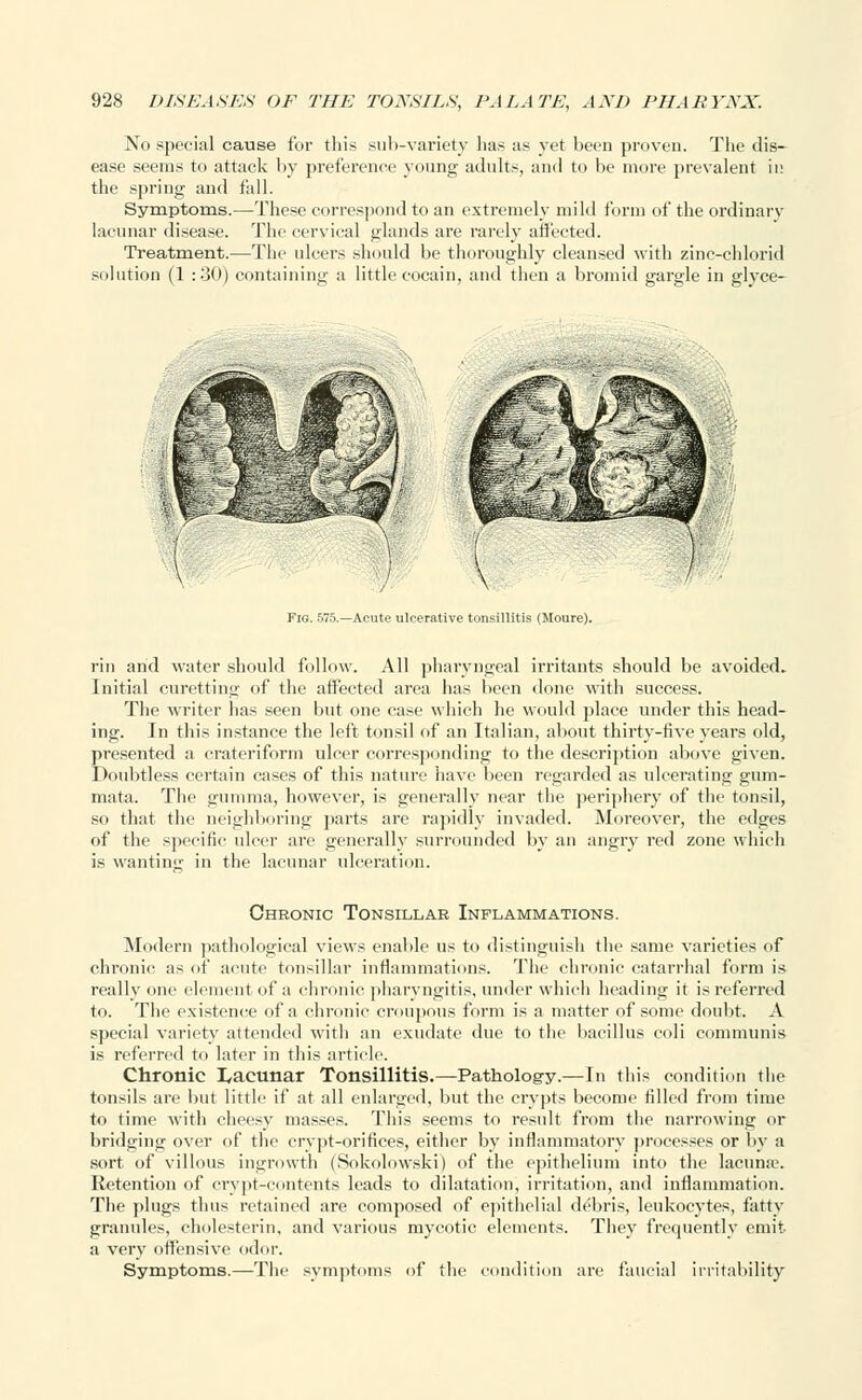 No special cause for this sub-variety has as yet been proven. The dis- ease seems to attack by preference young adults, and to be more prevalent in the spring and fall. Symptoms.—These correspond to an extremely mild form of the ordinary lacunar disease. The cervical glands are rarely affected. Treatment.—The ulcers should be thoroughly cleansed with zinc-chlorid solution (1 :30) containing a little cocain, and then a bromid gargle in glyce- \ Fig. 575.—Acute ulcerative tonsillitis (Moure). rin arid water should follow. All pharyngeal irritants should be avoided. Initial curetting of the affected area has been dune with success. The writer has seen but one case which he would place under this head- ing. In this instance the left tonsil of an Italian, about thirty-five years old, presented a crateriform ulcer corresponding to the description above given. Doubtless certain cases of this nature have been regarded as ulcerating gum- mata. The gumma, however, is generally near the periphery of the tonsil, so that the neighboring parts are rapidly invaded. Moreover, the edges of the specific ulcer arc generally surrounded by an angry red zone which is wanting in the lacunar ulceration. Chronic Tonsillar Inflammations. Modern pathological views enable us to distinguish the same varieties of chronic as of acute tonsillar inflammations. The chronic catarrhal form is really one element of a chronic pharyngitis, under which heading it is referred to. The existence of a chronic croupous form is a matter of some doubt. A special variety attended with an exudate due to the bacillus coli communis is referred to later in this article. Chronic I,acunar Tonsillitis.—Pathology.—In this condition the tonsils are but little if at all enlarged, but the crypts become filled from time to time with cheesy masses. This seems to result from the narrowing or bridging over of the crypt-orifices, either by inflammatory processes or by a sort of villous ingrowth (Sokolowski) of the epithelium into the lacunae. Retention of crypt-contents leads to dilatation, irritation, and inflammation. The plugs thus retained are composed of epithelial debris, leukocytes, fatty granules, cholesterin, and various mycotic elements. They frequently emit a very offensive odor. Symptoms.—The symptoms of the condition are faucial irritability